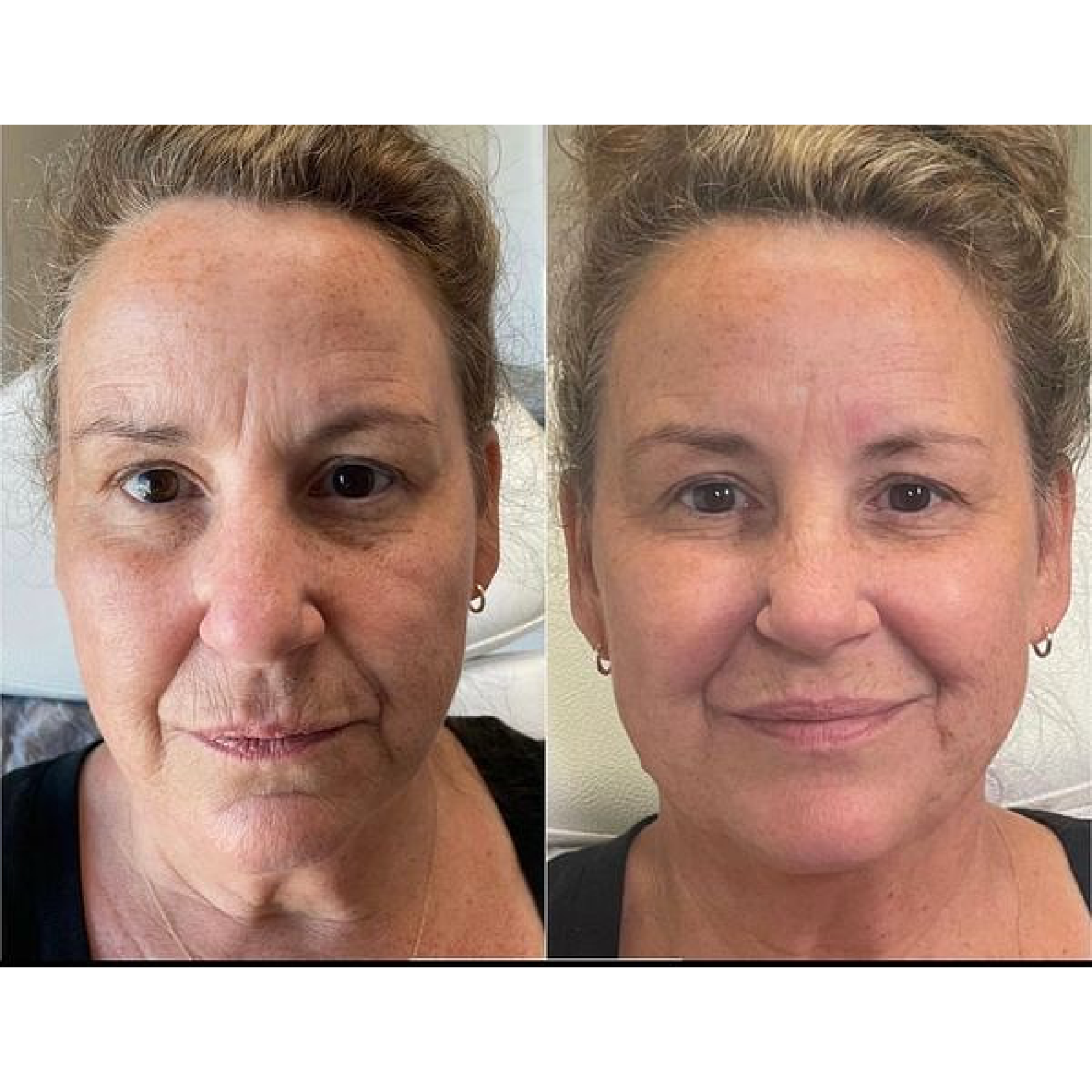 Full Face Rejuvenation
Before & 2 weeks after treatment