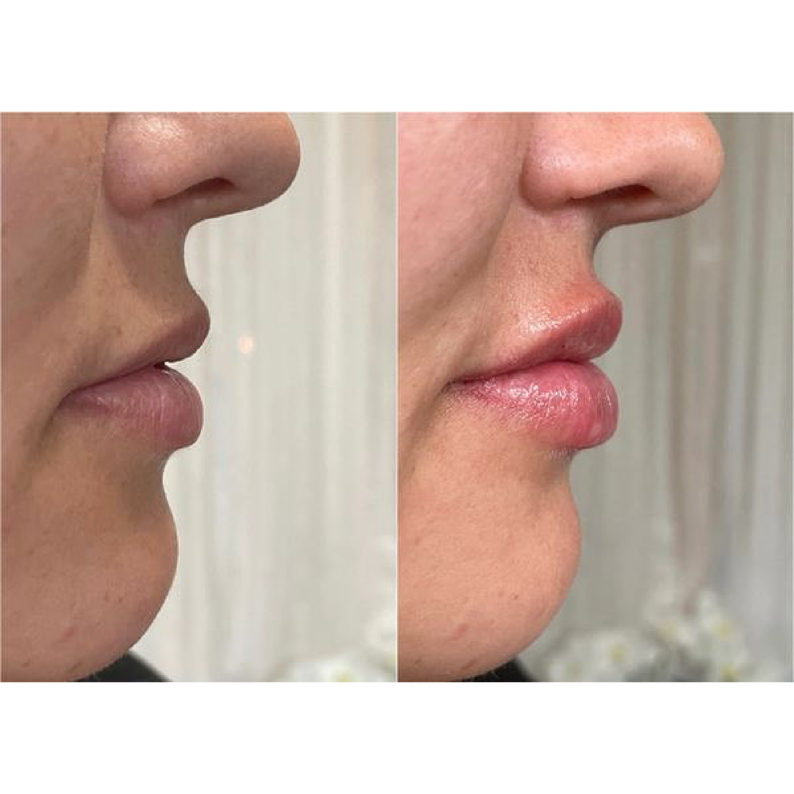 Lip Filler
Before & Immediately After Treatment