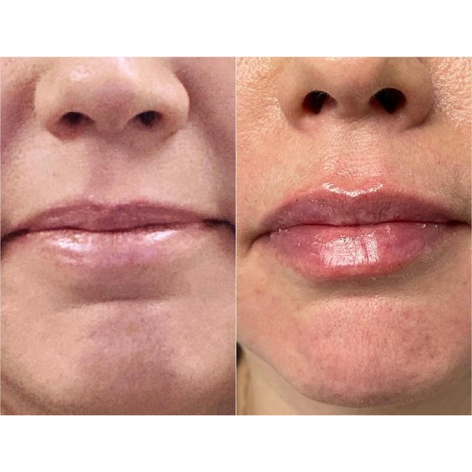 Lip Filler
Before & Immediately After Treatment