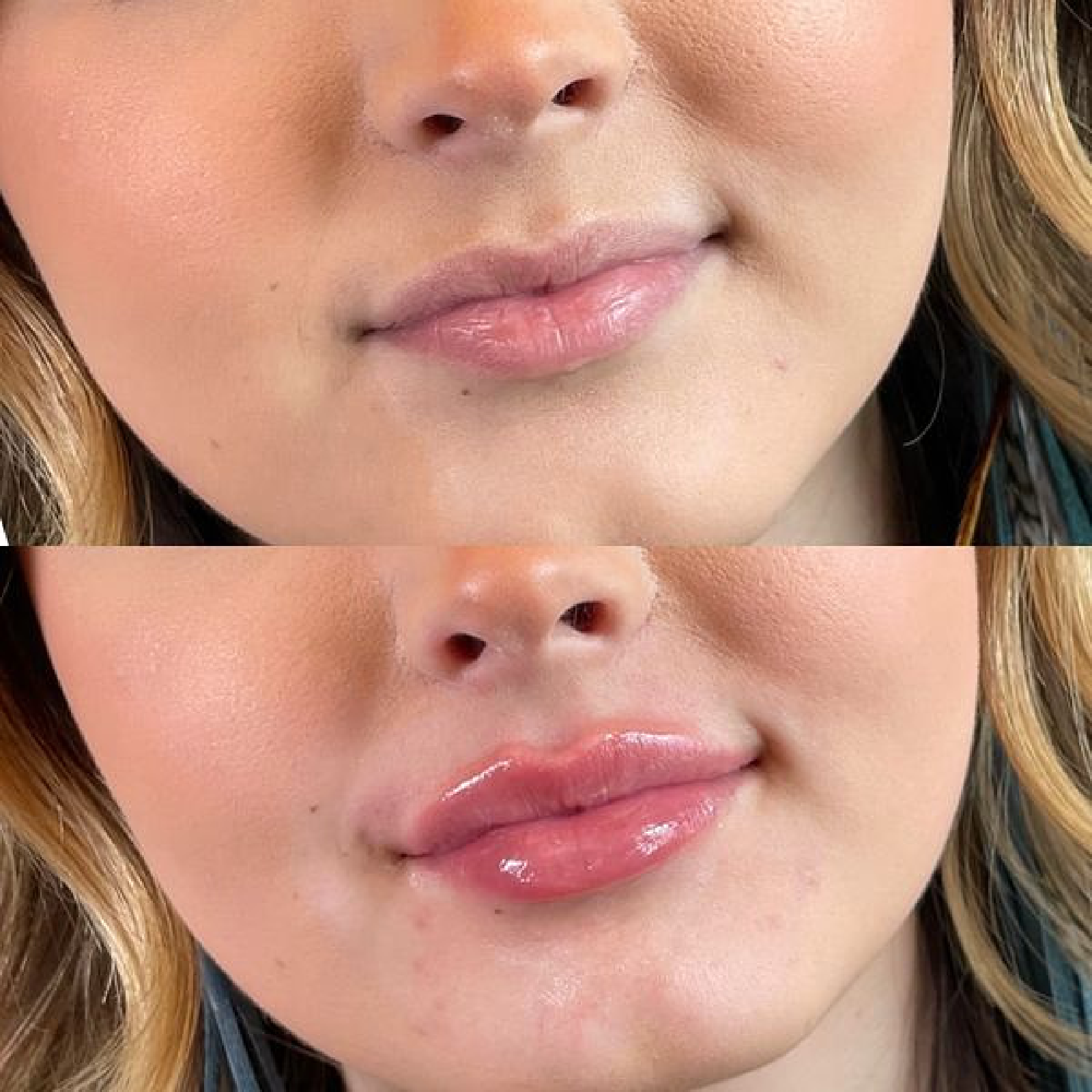 Lip Filler
Before & Immediately After Treatment