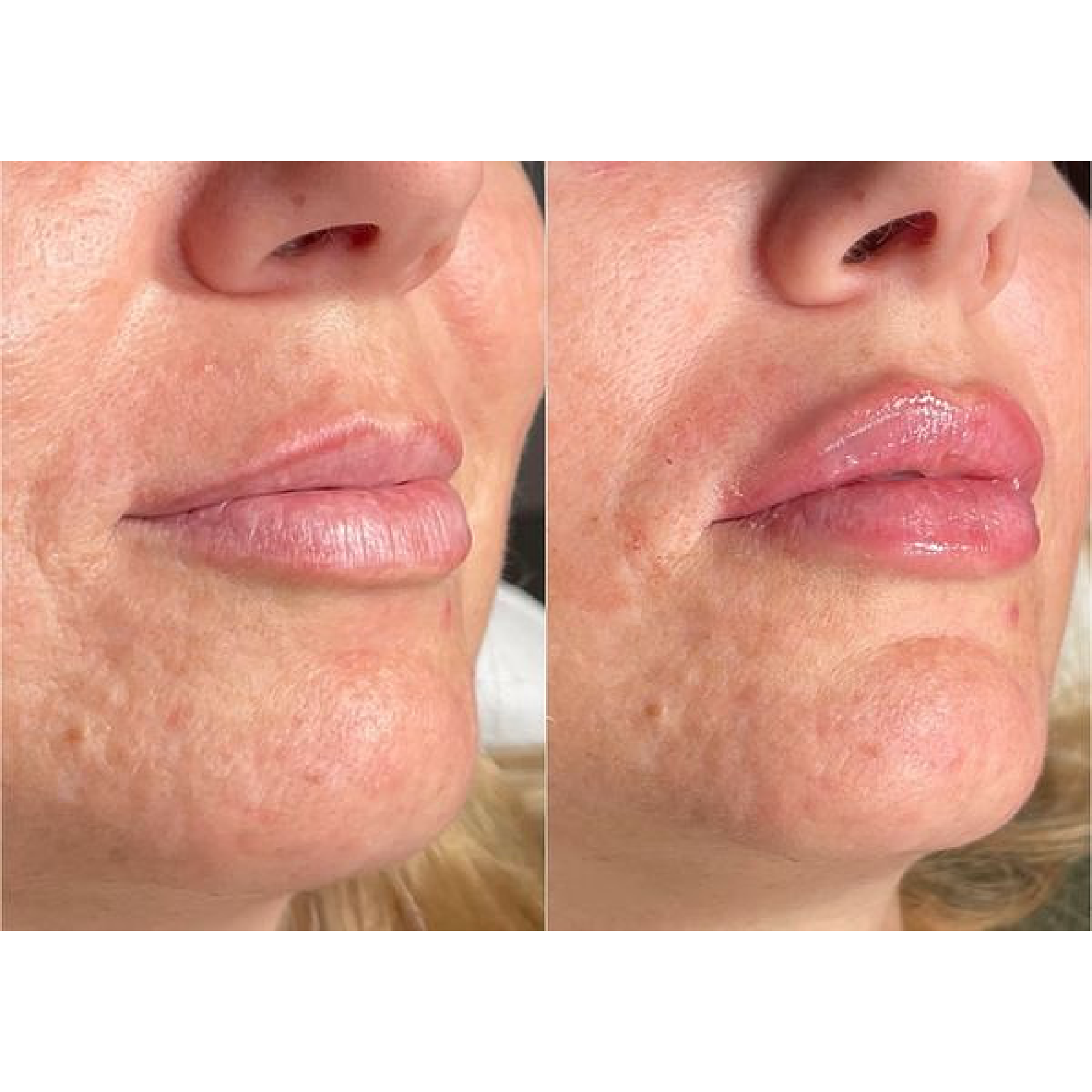 Lip Filler
Before & Immediately After treatment