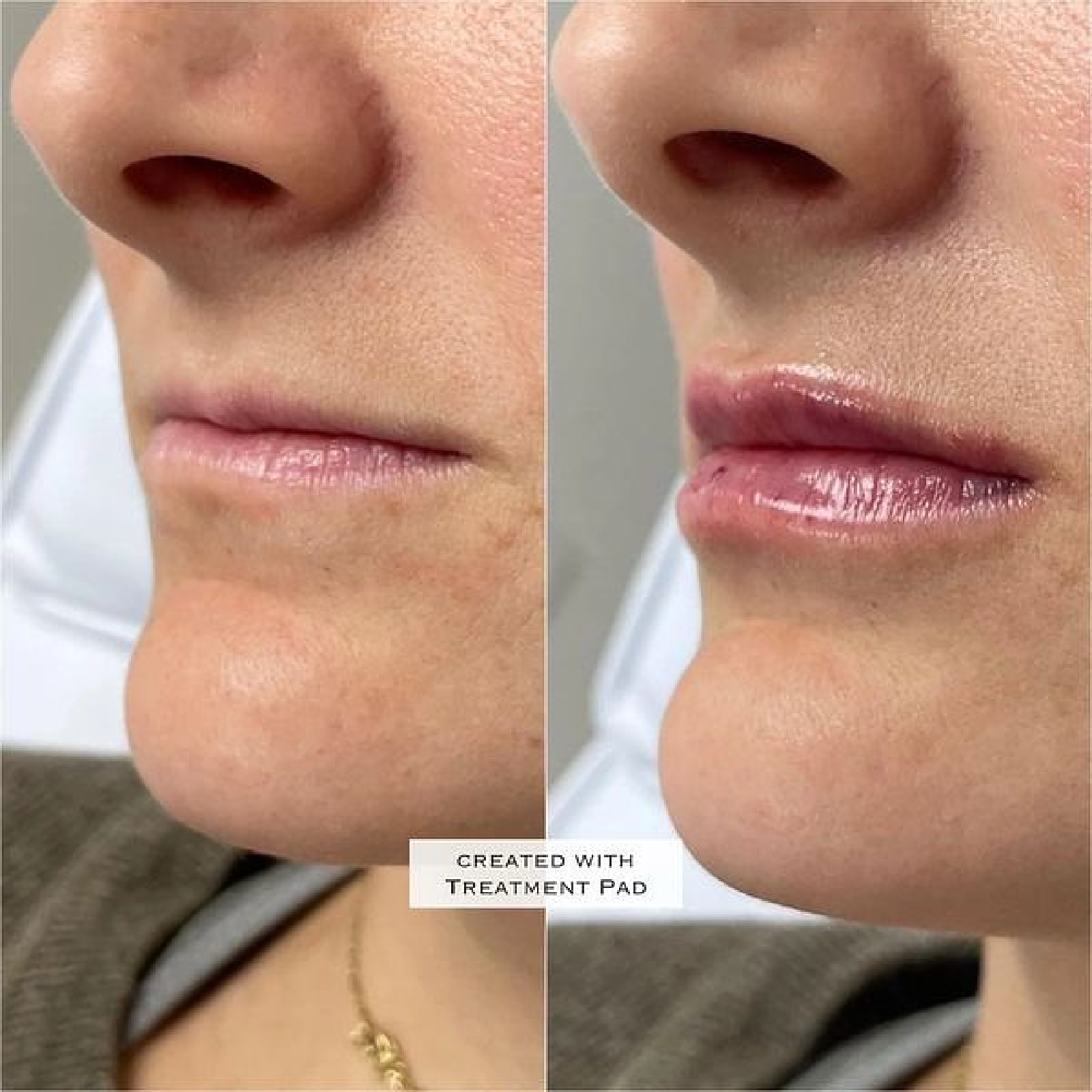 Lip Filler
Before & Immediately after treatment