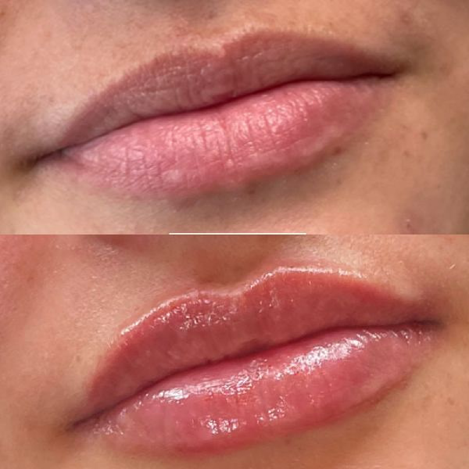 Lip Filler 
Before & Immediately After Treatment