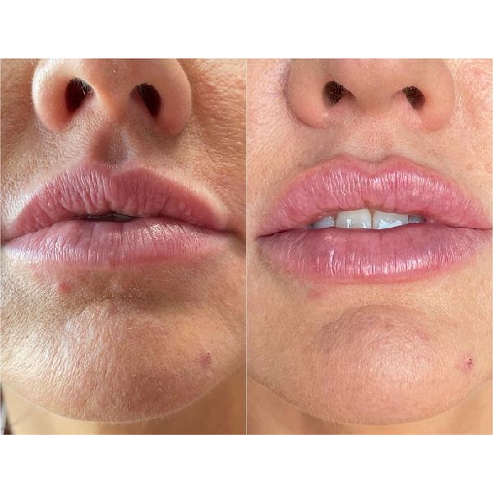 Lip Filler
Before & Immediately After Treatment