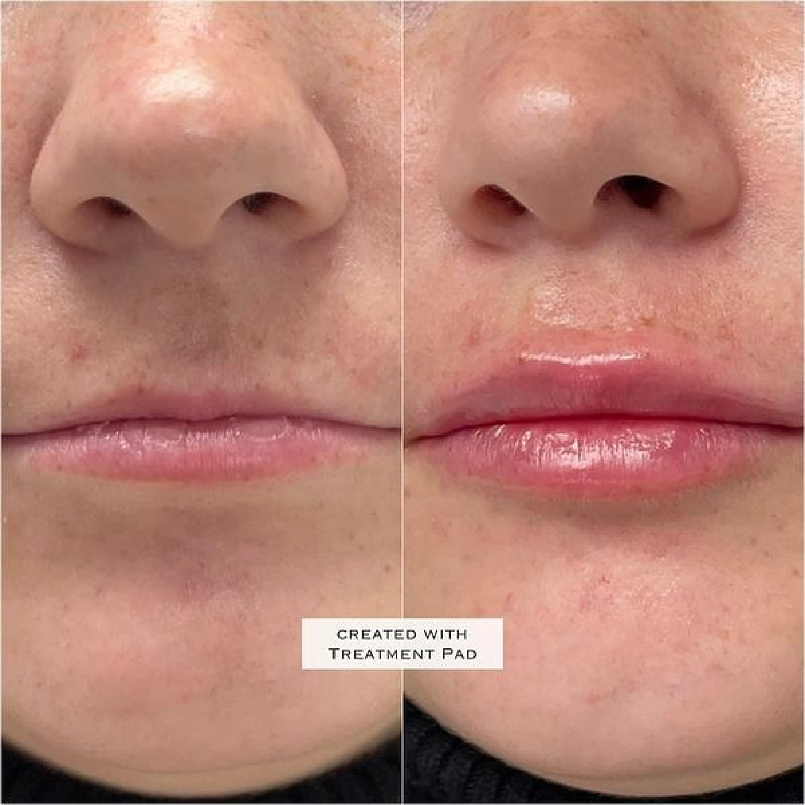 Lip Filler
Before & Immediately After Treatment