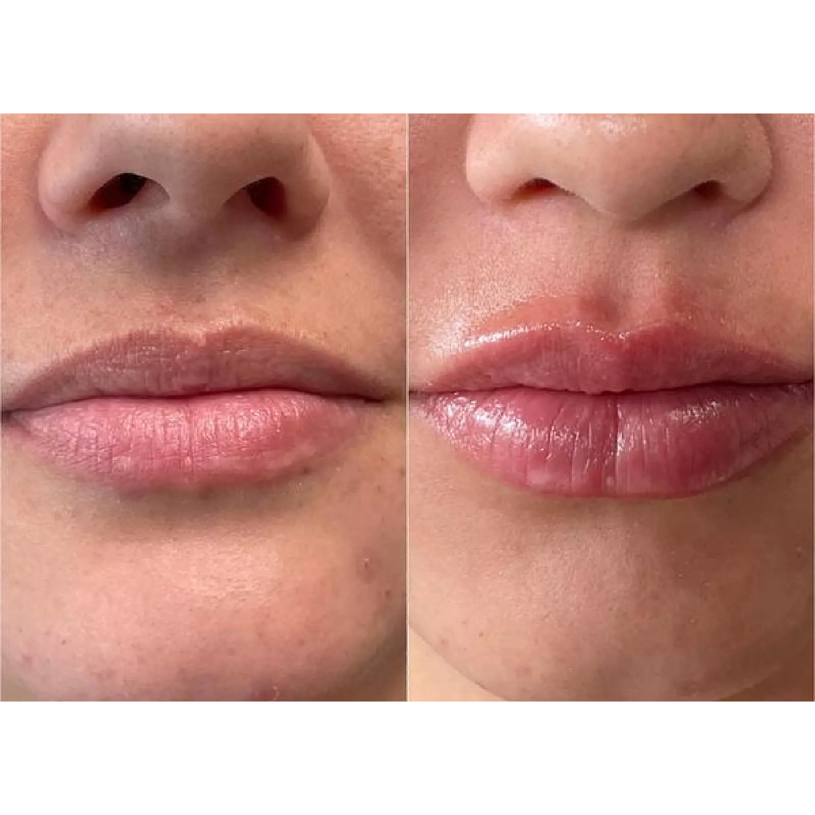 Lip Filler
Before & Immediately after treatment