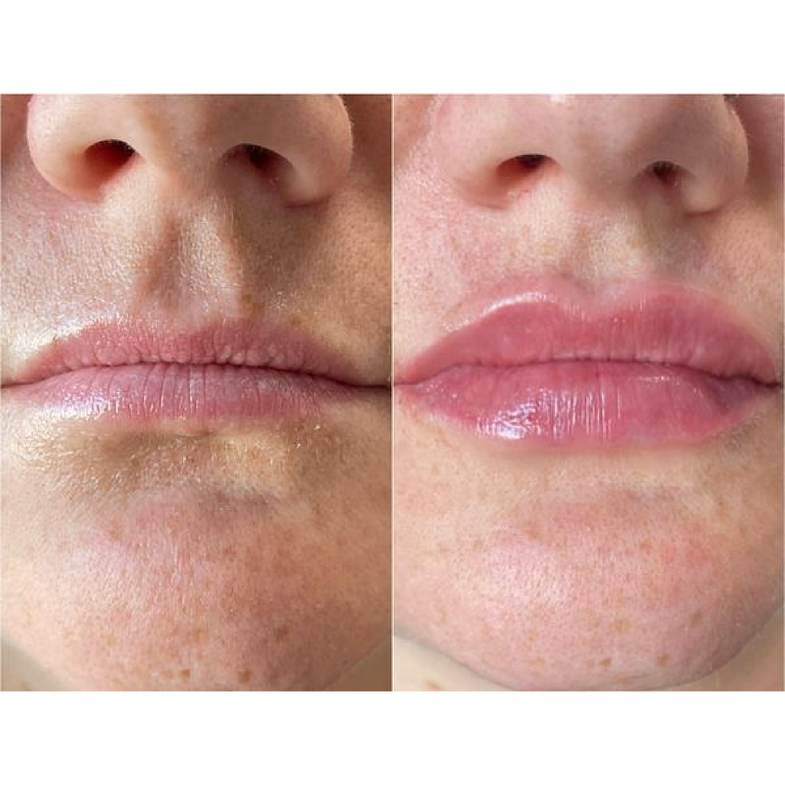 Lip Filler
Before & Immediately after treatment