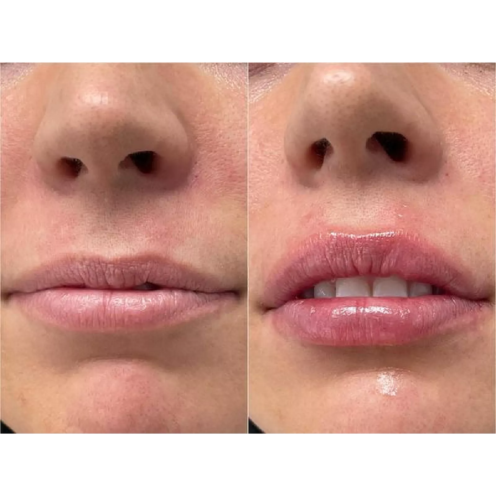 Lip Filler
Before & Immediately After Treatment