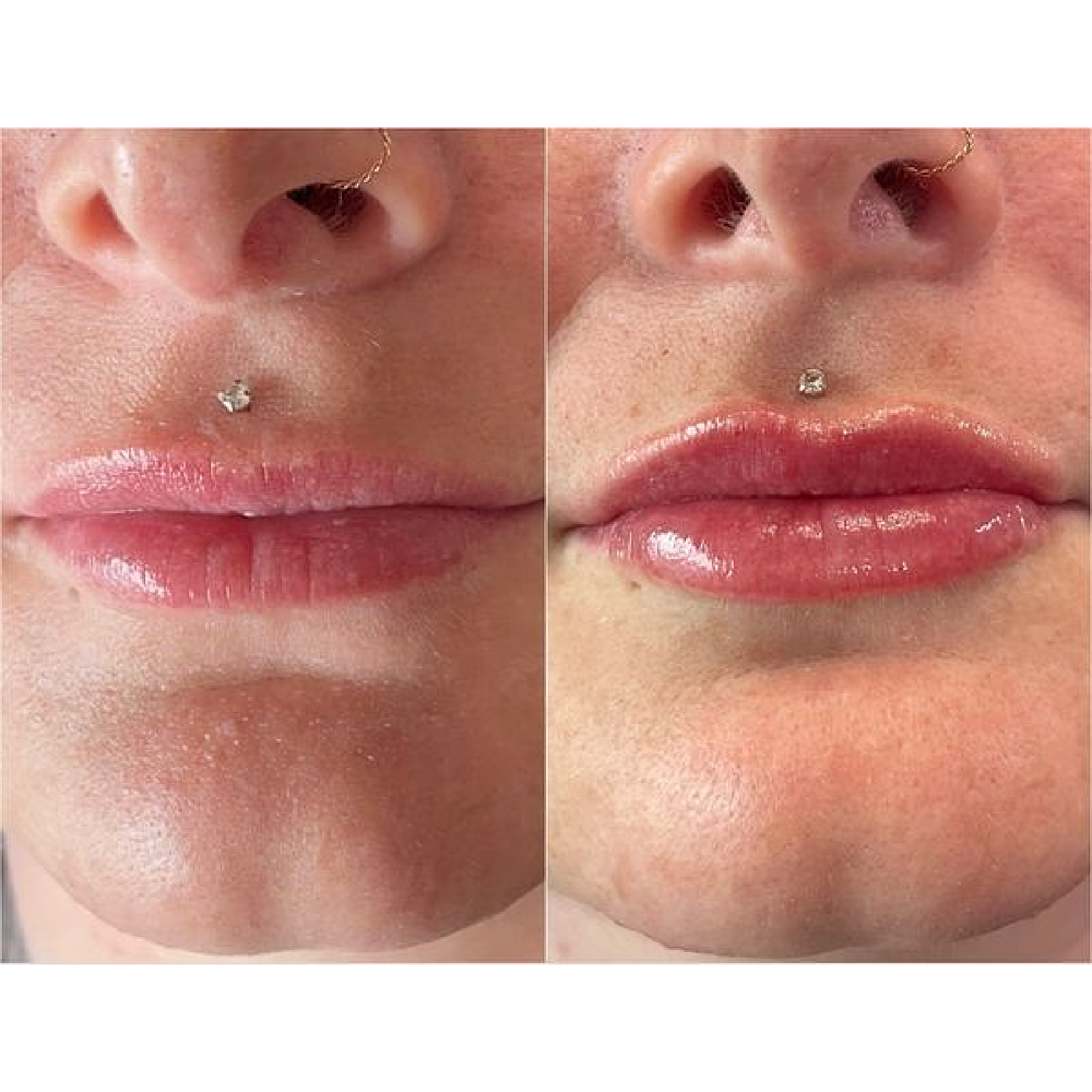 Lip Filler
Before & Immediately after treatment