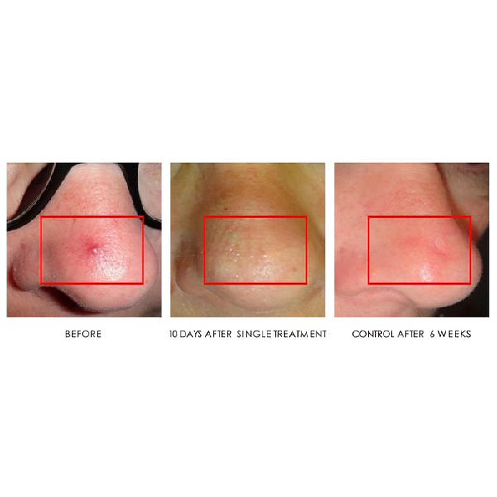 Spider Nevus Treatment
# of treatments: 1