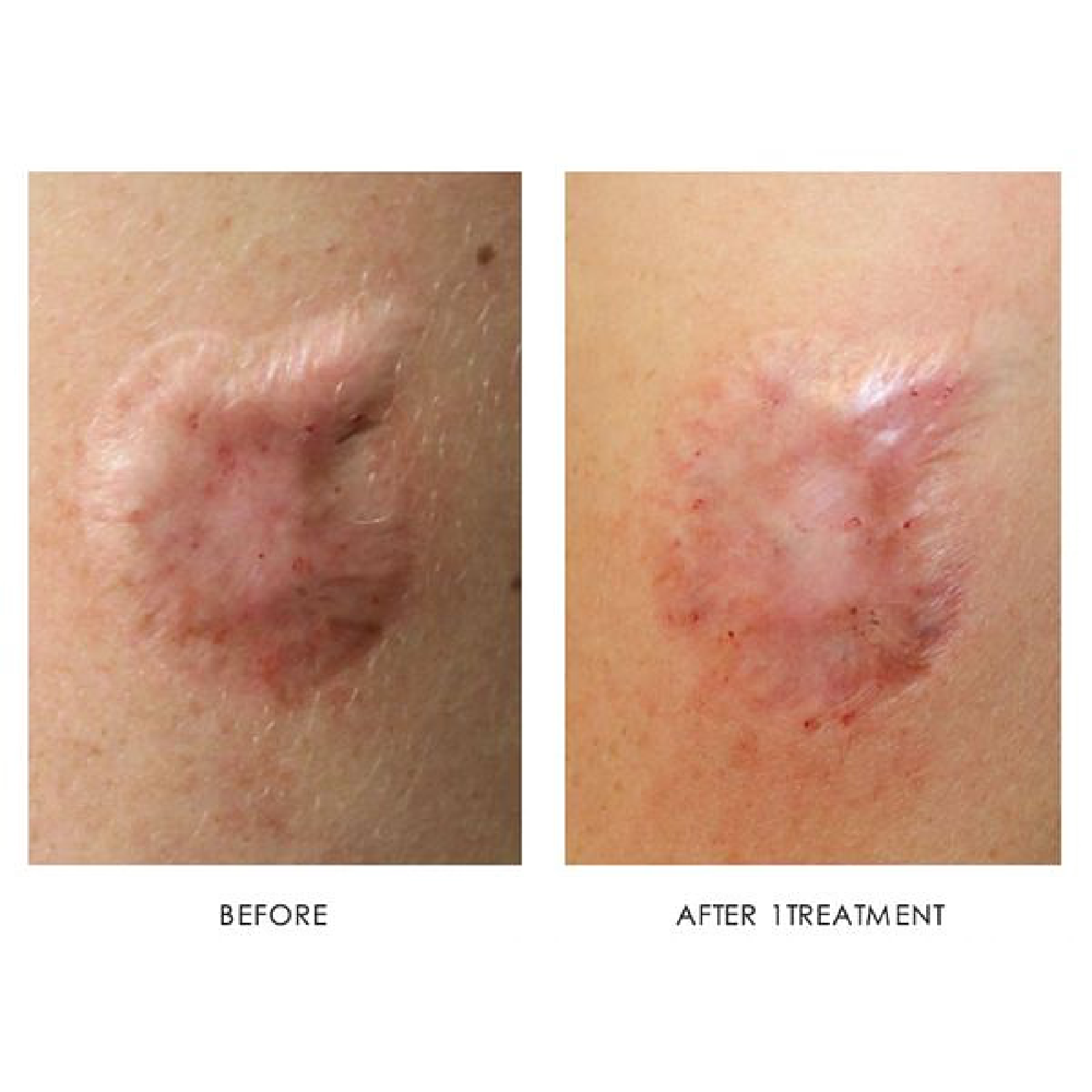 Scar Treatment
# of treatments: 1