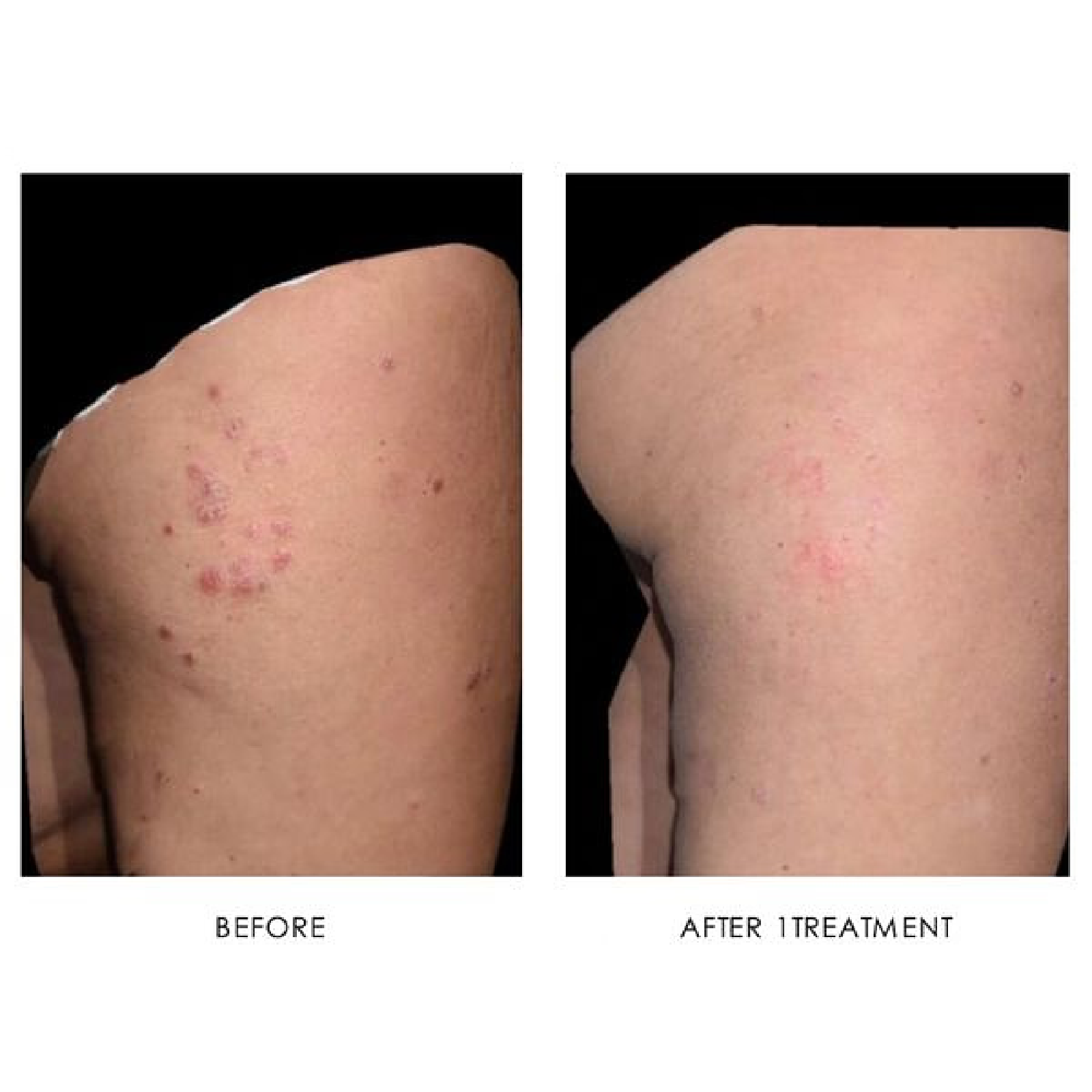 Psoriasis Treatment:
# of Treatments: 1