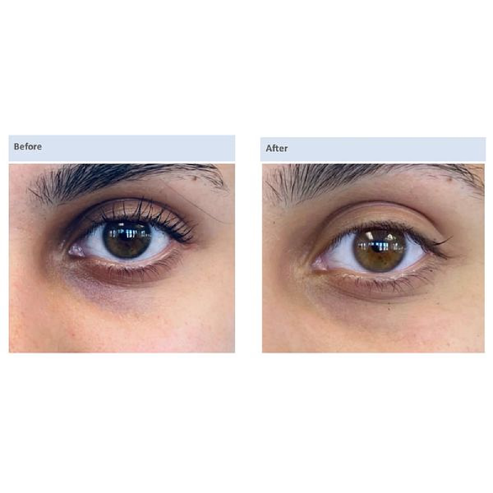 Darkened Under-Eyes & Eye-lids
# of treatments: 2