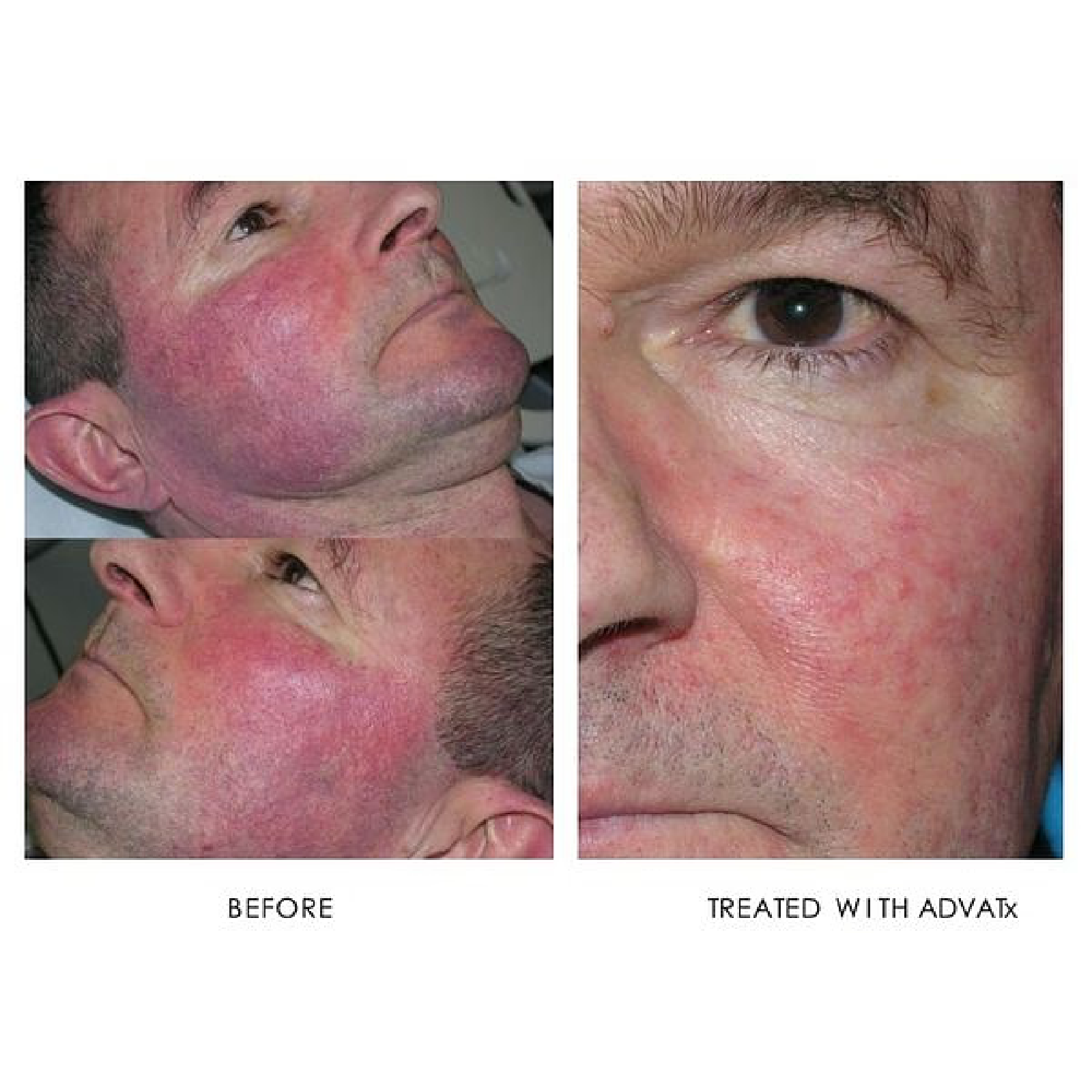 Rosacea Treatment
# of treatments:1
After taken at 3 month follow up