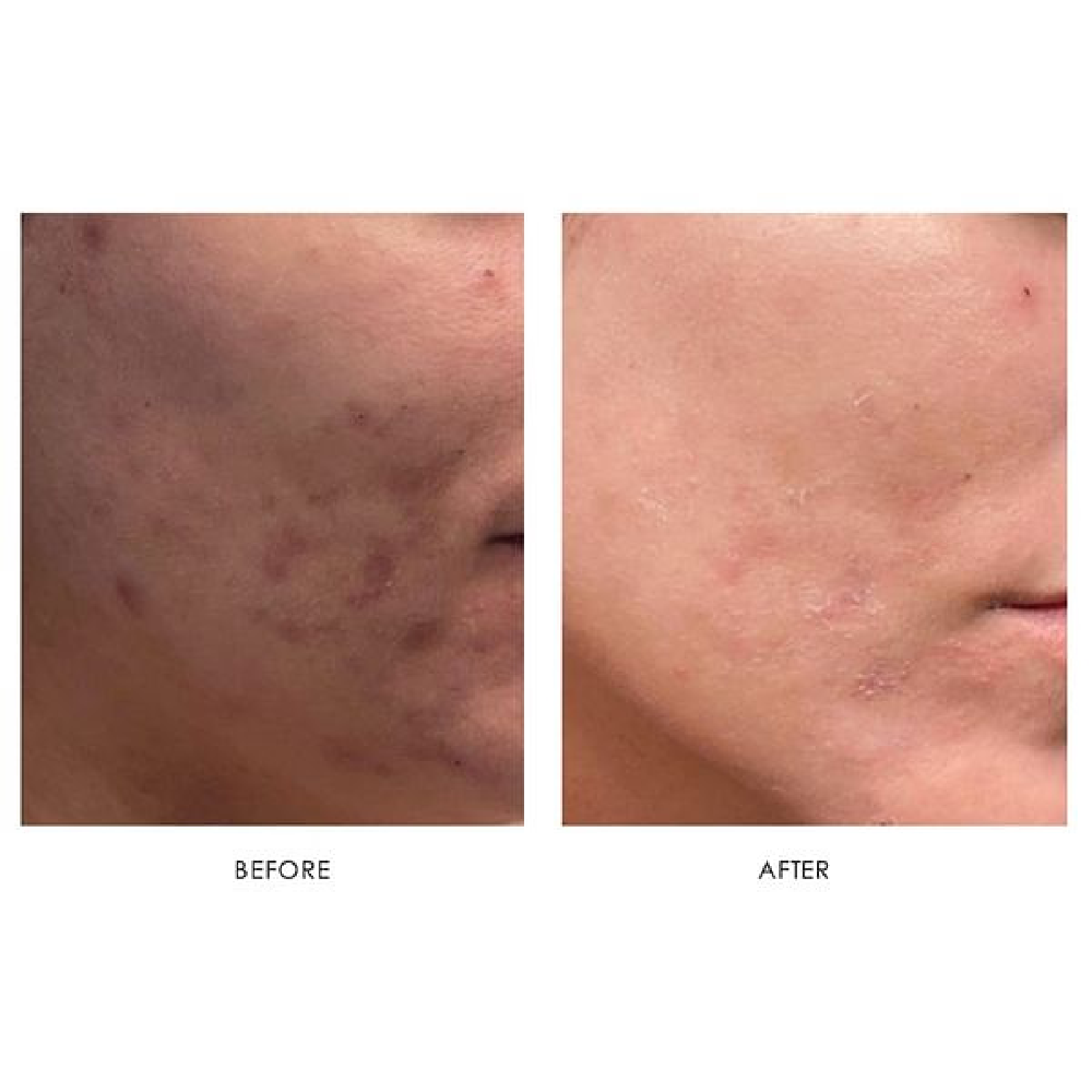 Acne & Acne Scarring
# of treatments: 1