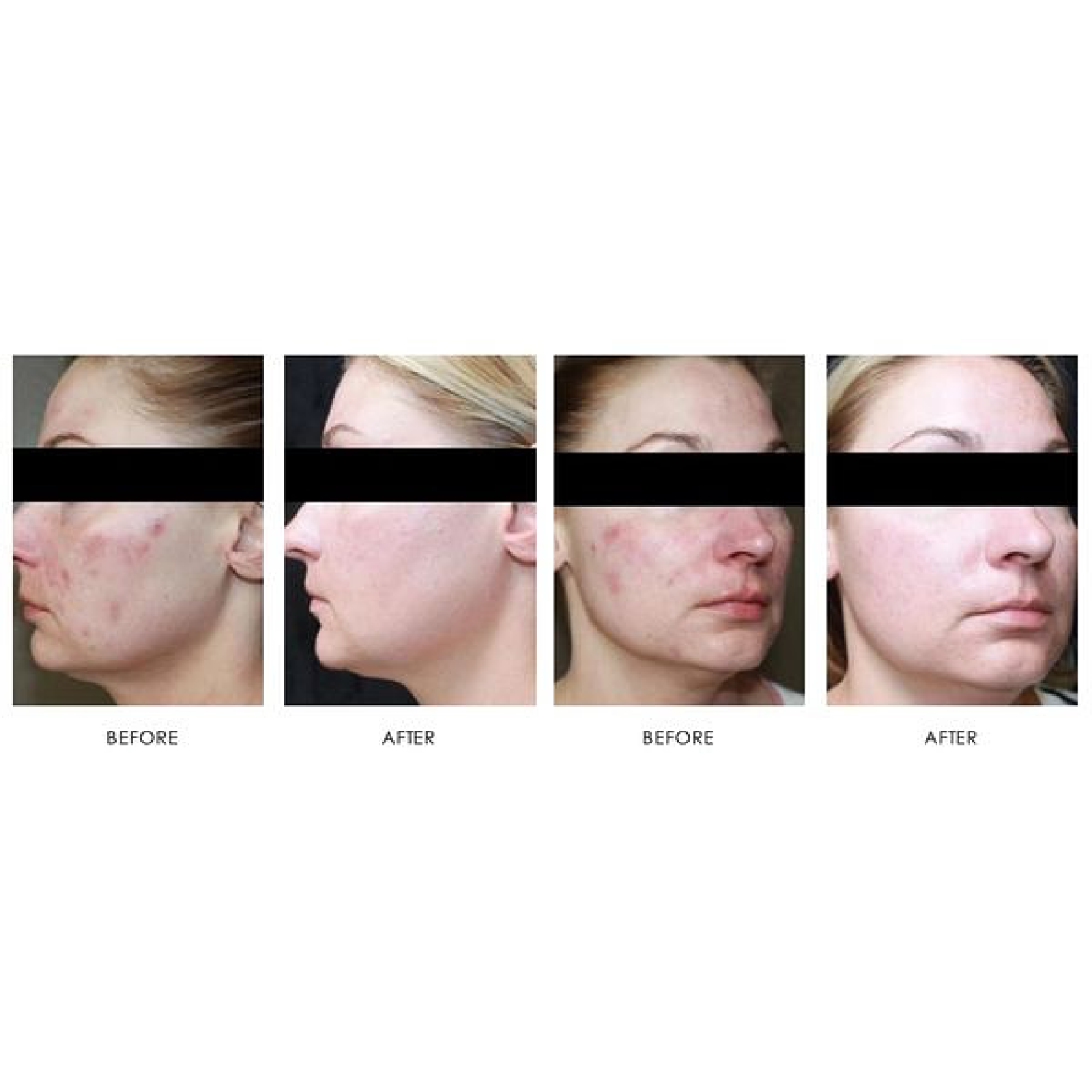 Acne & Acne Scarring
# of treatments: 1