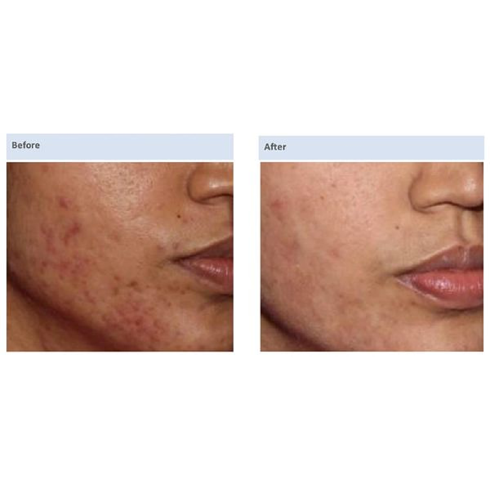 Acne & Acne Scars
# of treatments: 3