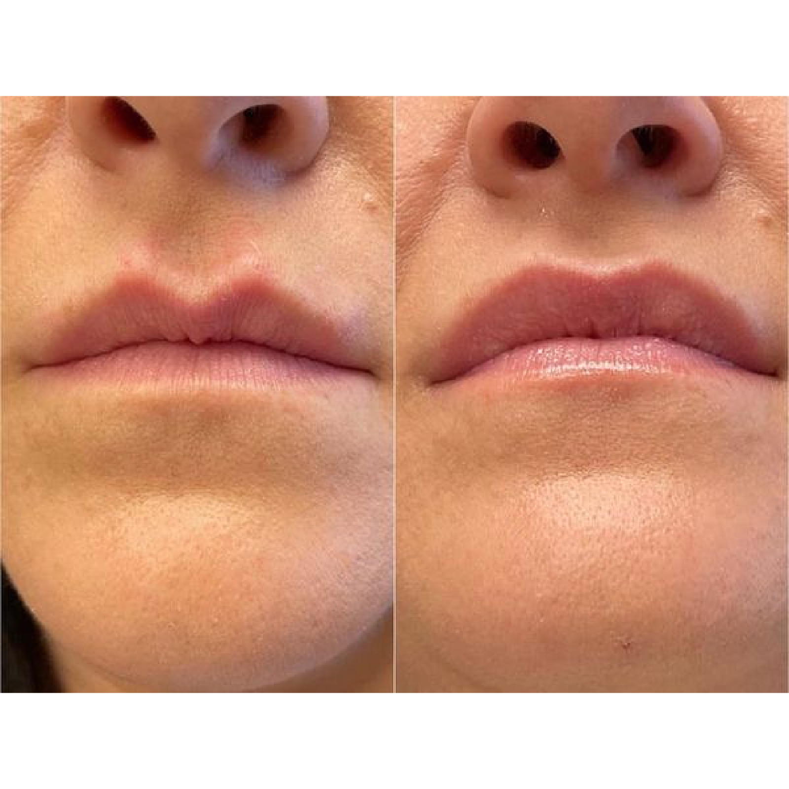 Gallery Botox Image Five In Helena MT | Fyre Aesthetics
