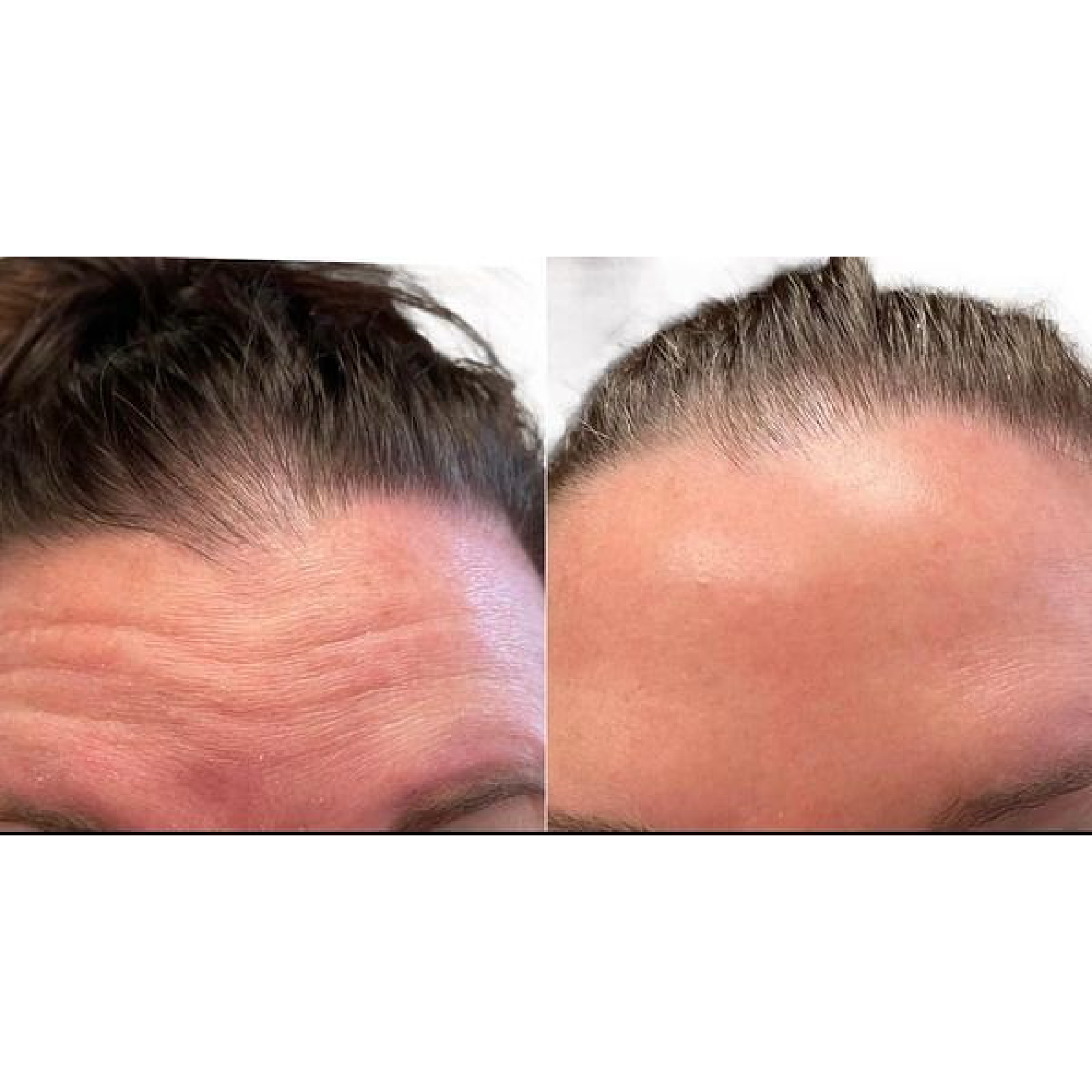 Gallery Botox Image Four In Helena MT | Fyre Aesthetics