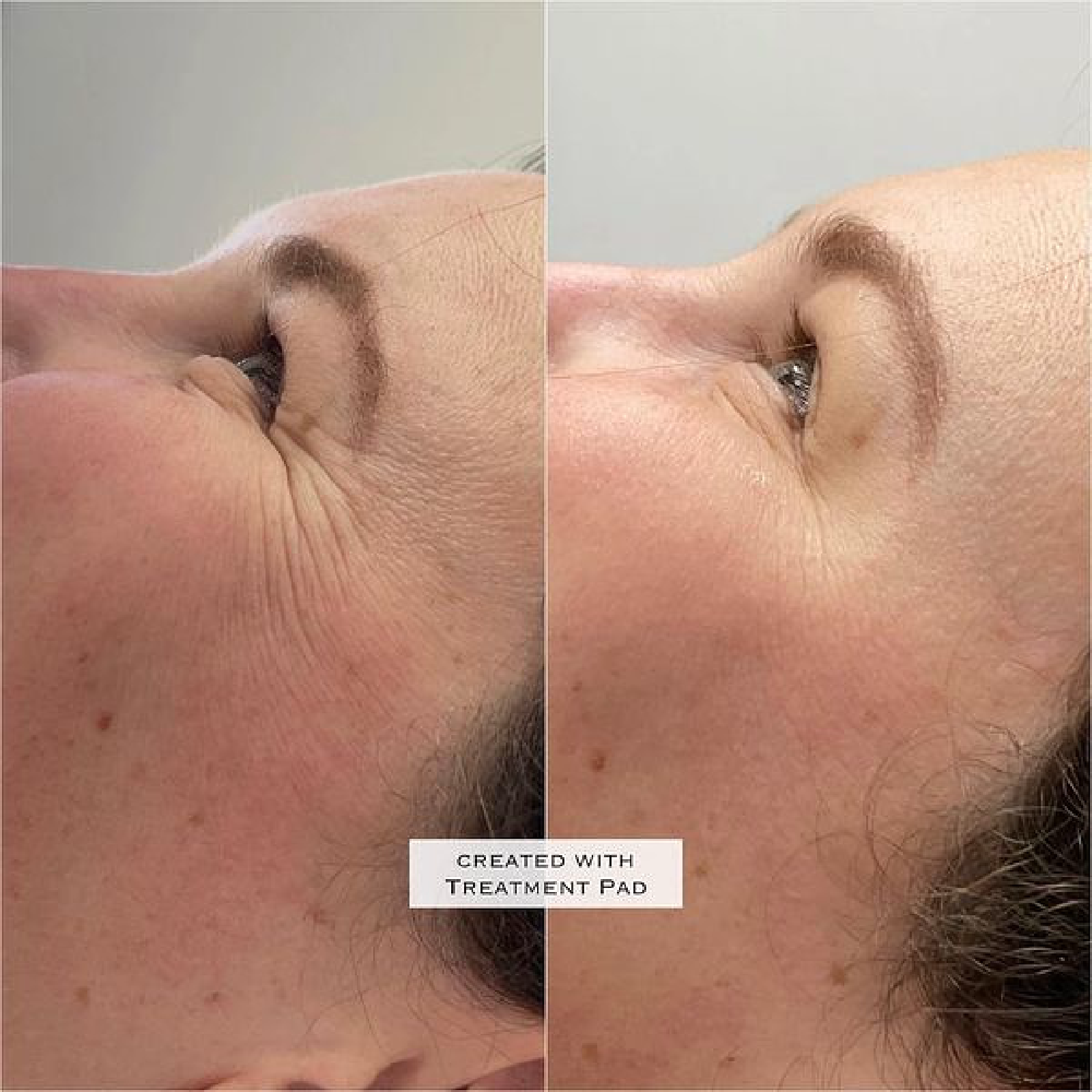 Gallery Botox Image One In Helena MT | Fyre Aesthetics
