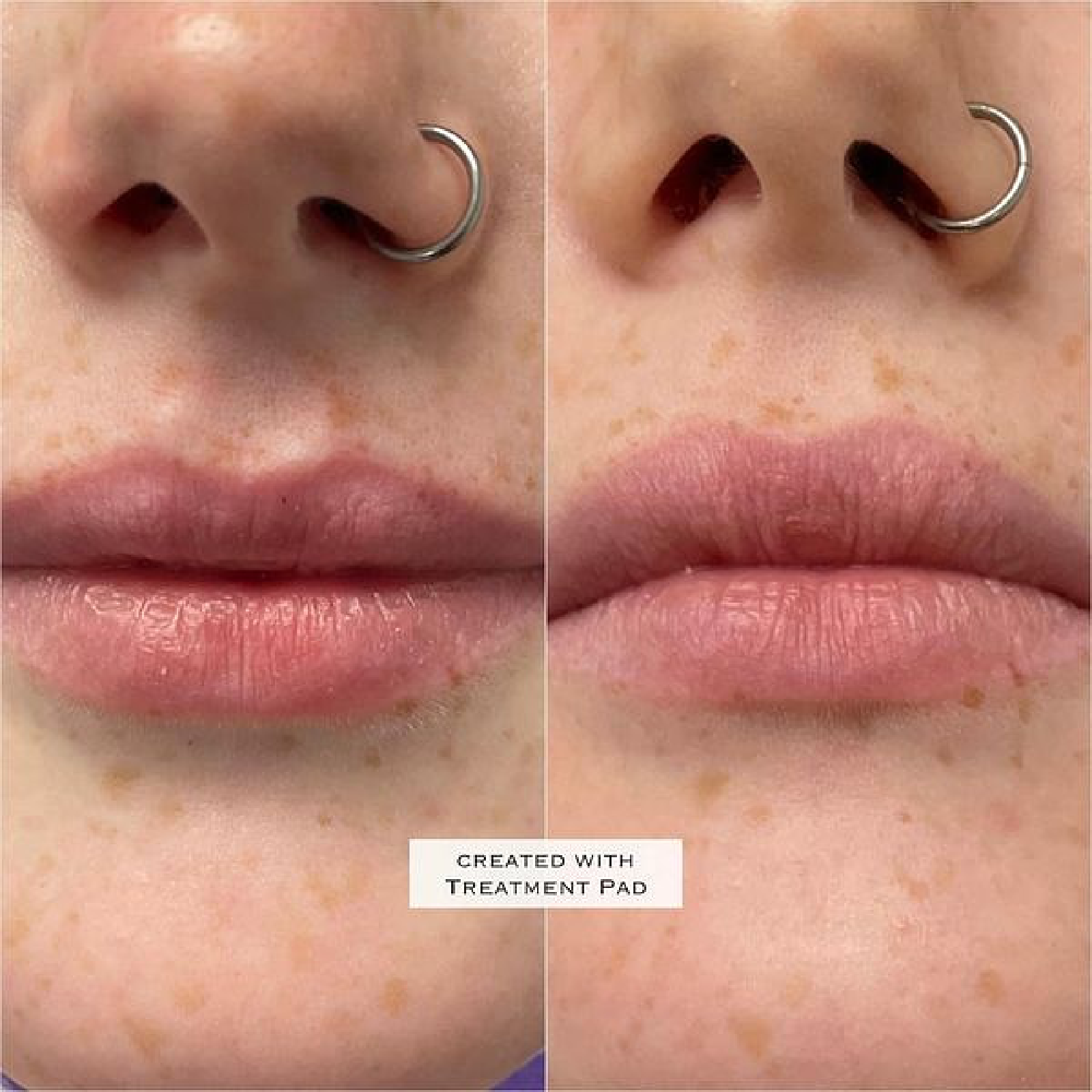 Gallery Botox Image Seven In Helena MT | Fyre Aesthetics