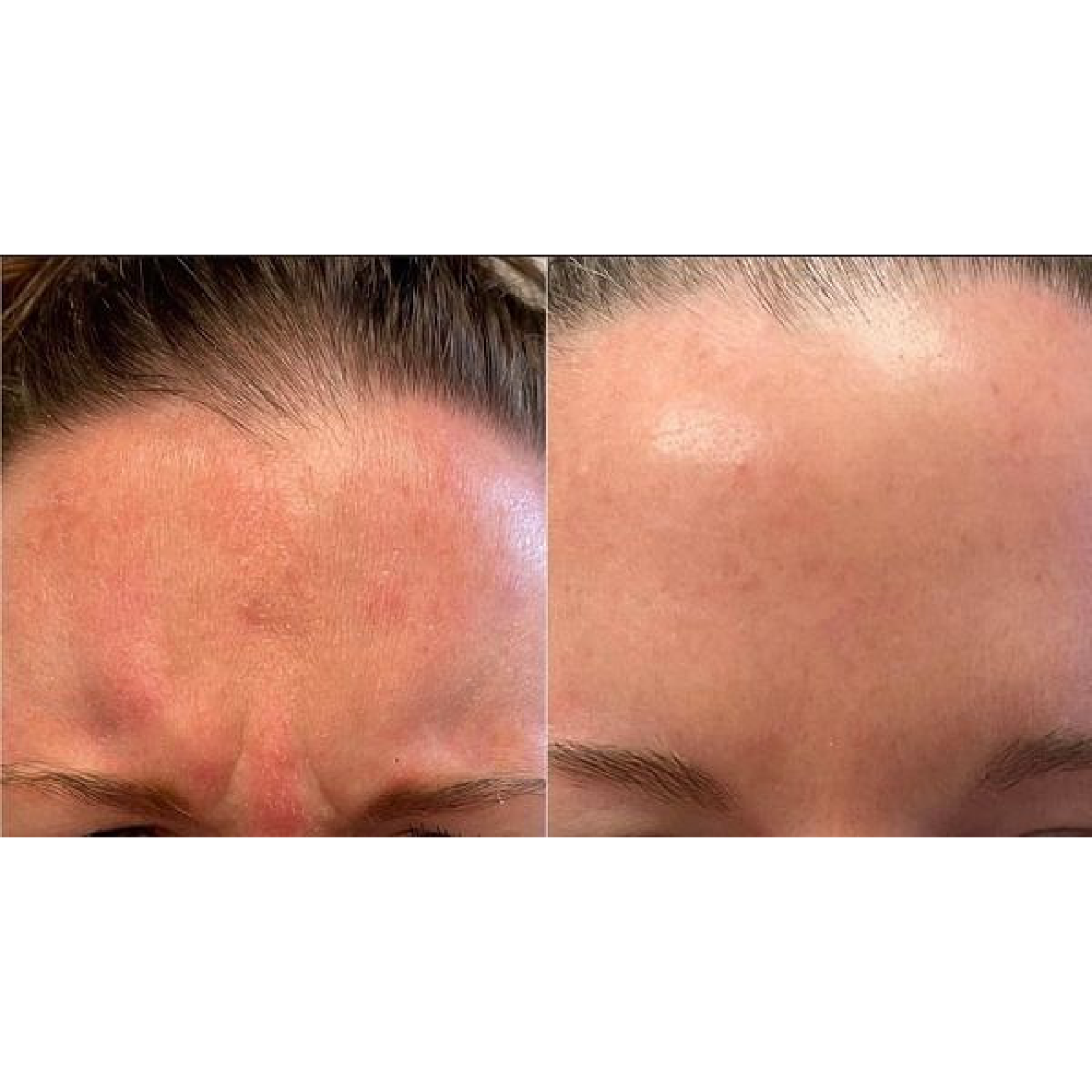 Gallery Botox Image Six In Helena MT | Fyre Aesthetics