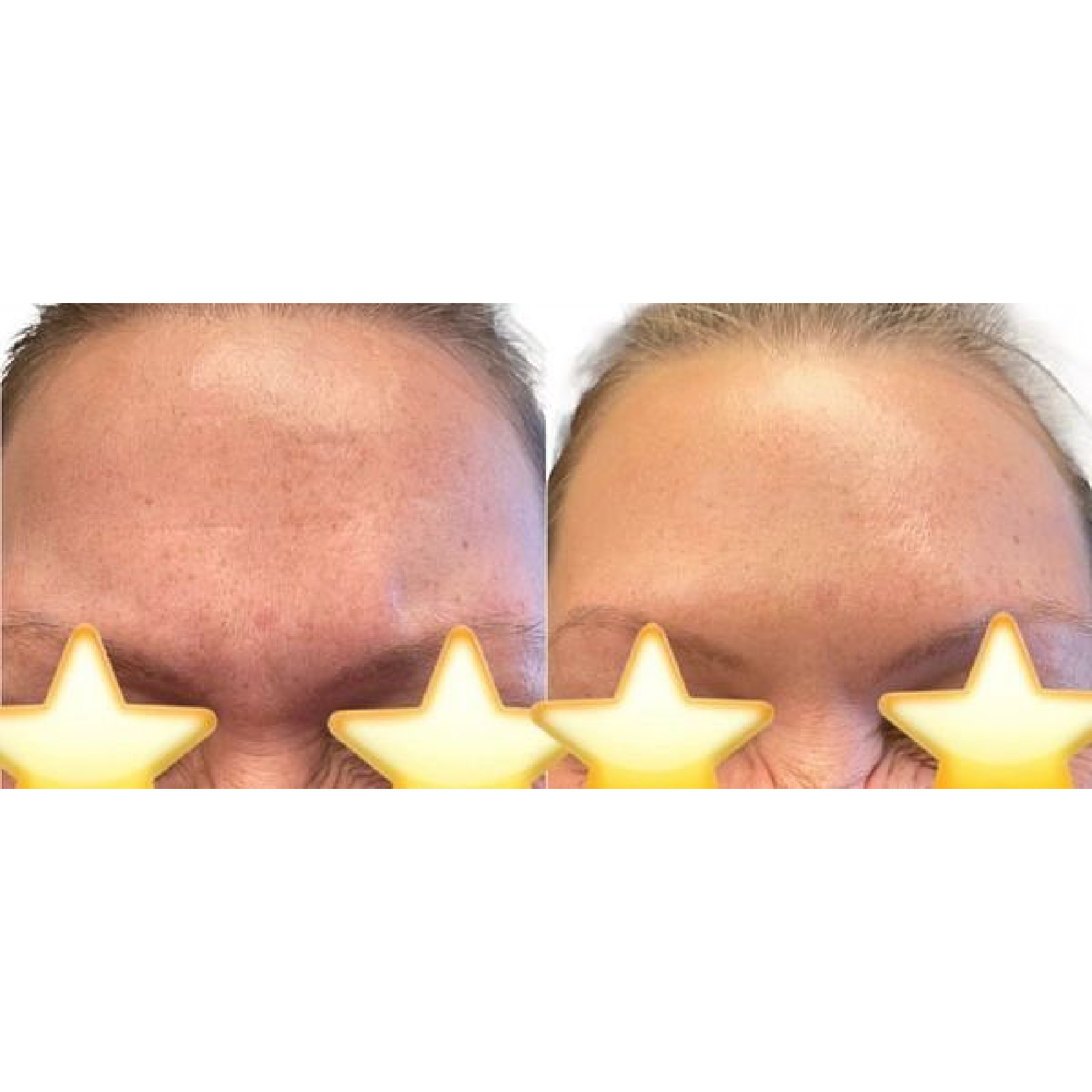 Gallery Botox Image Three In Helena MT | Fyre Aesthetics