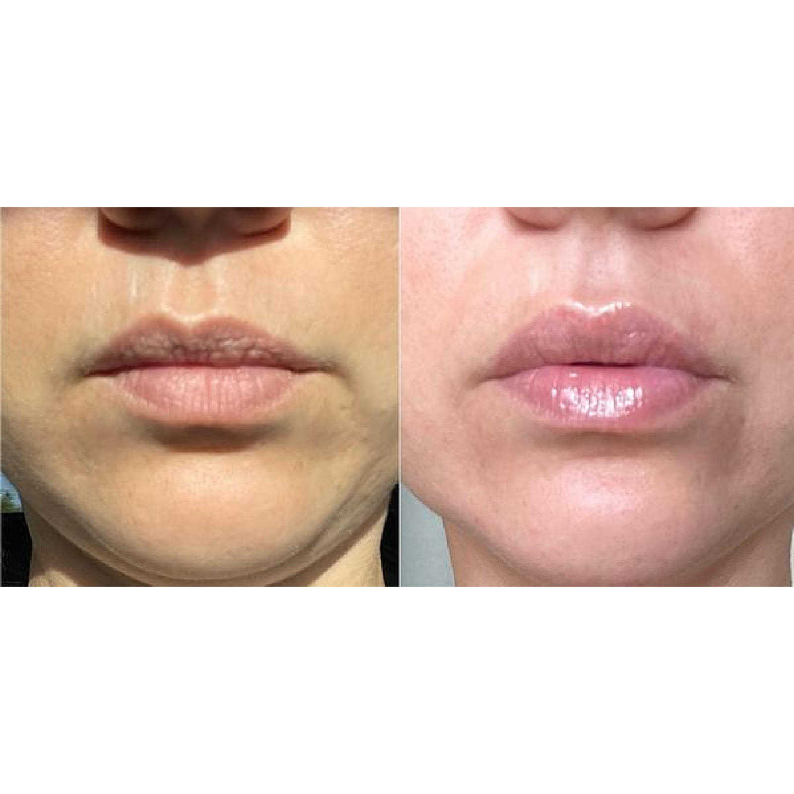 Gallery Botox Image Two In Helena MT | Fyre Aesthetics