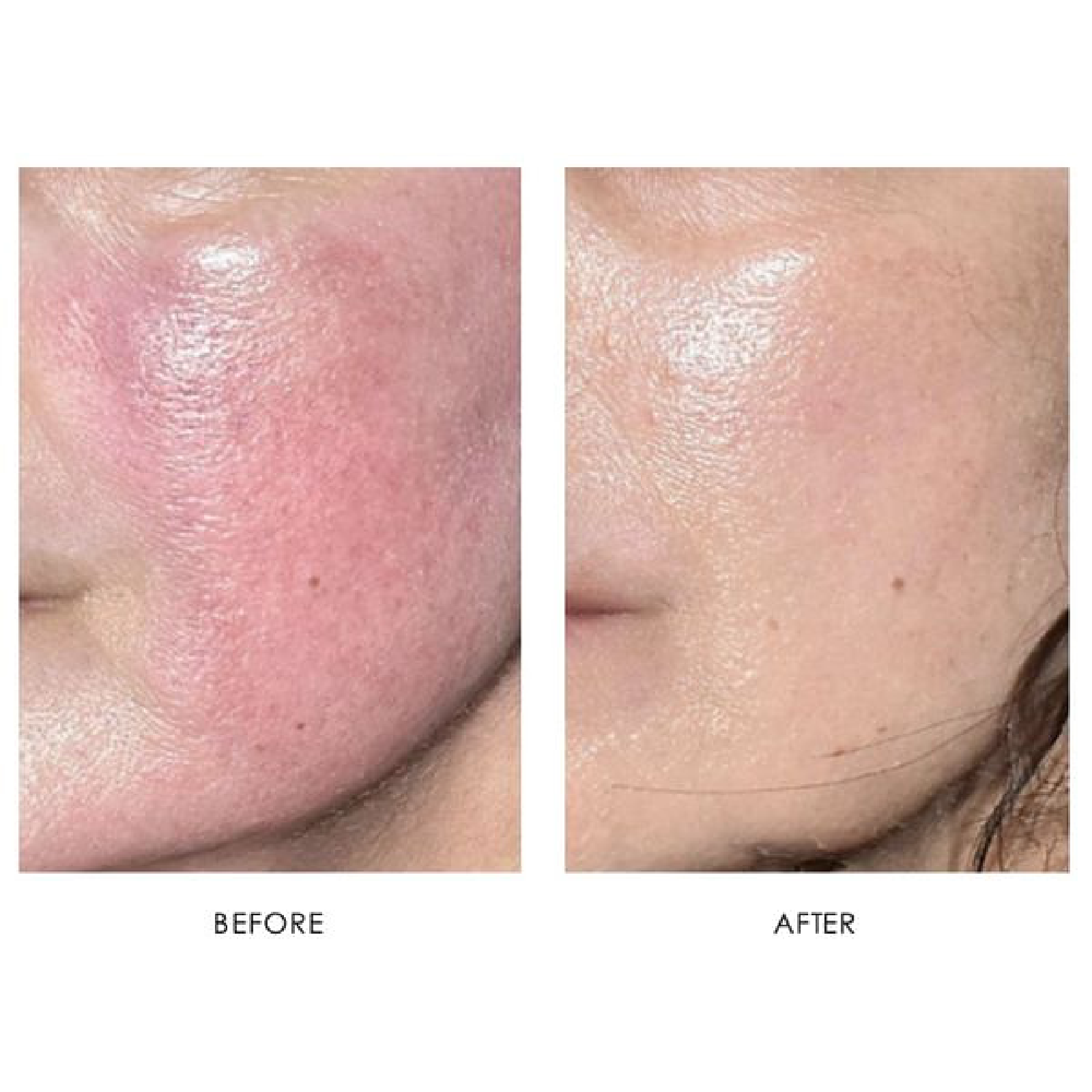 Gallery Laser Image Eleven In Helena MT | Fyre Aesthetics