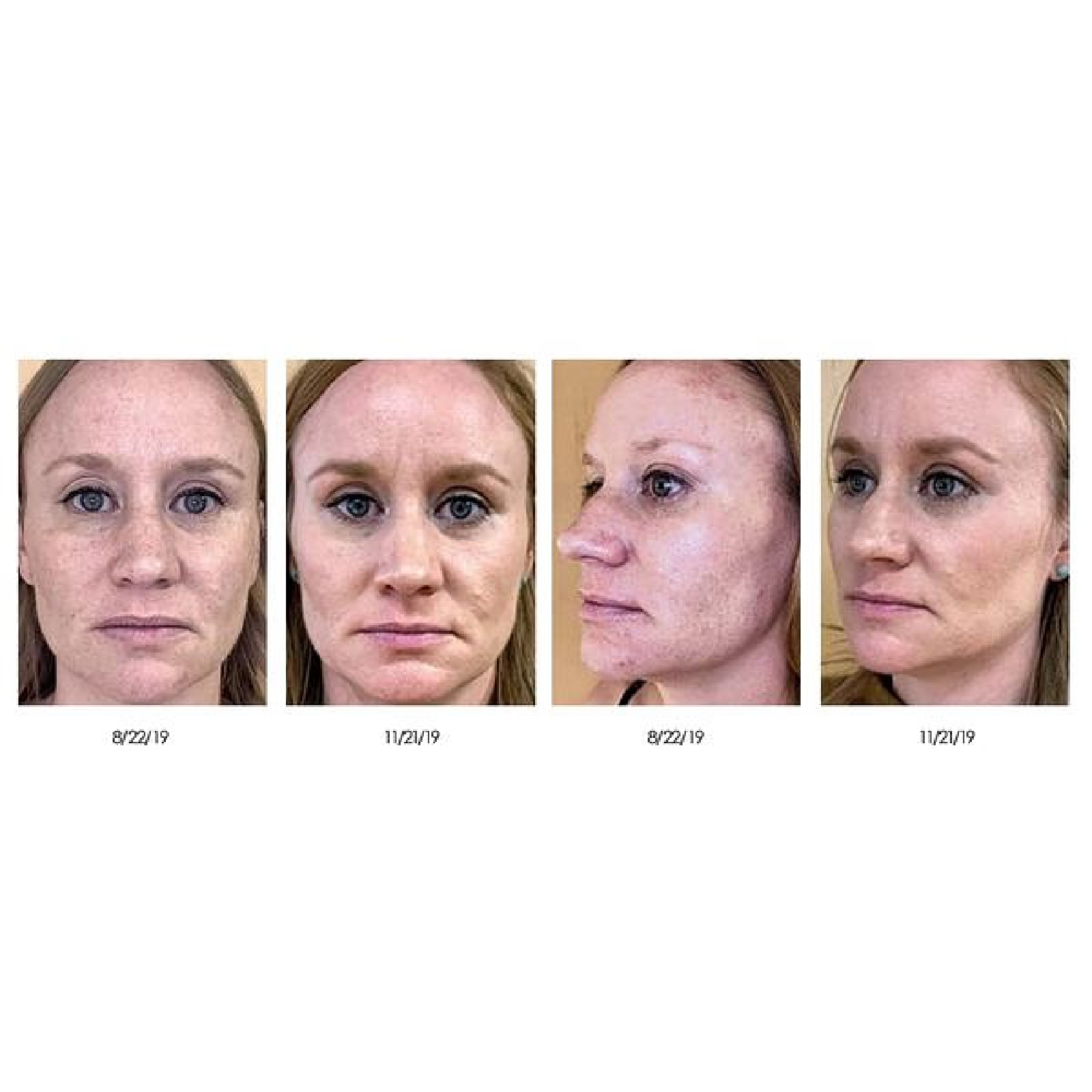 Gallery Laser Image Five In Helena MT | Fyre Aesthetics