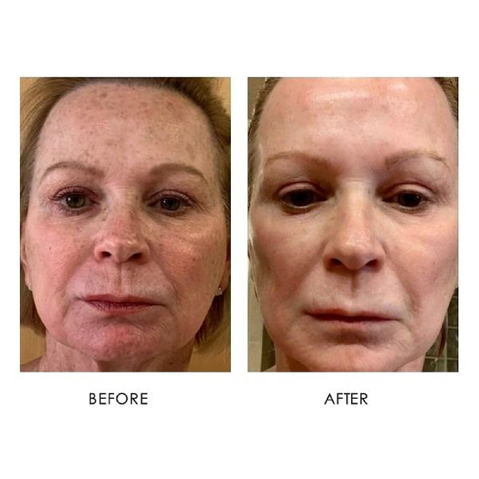 Gallery Laser Image Four In Helena MT | Fyre Aesthetics