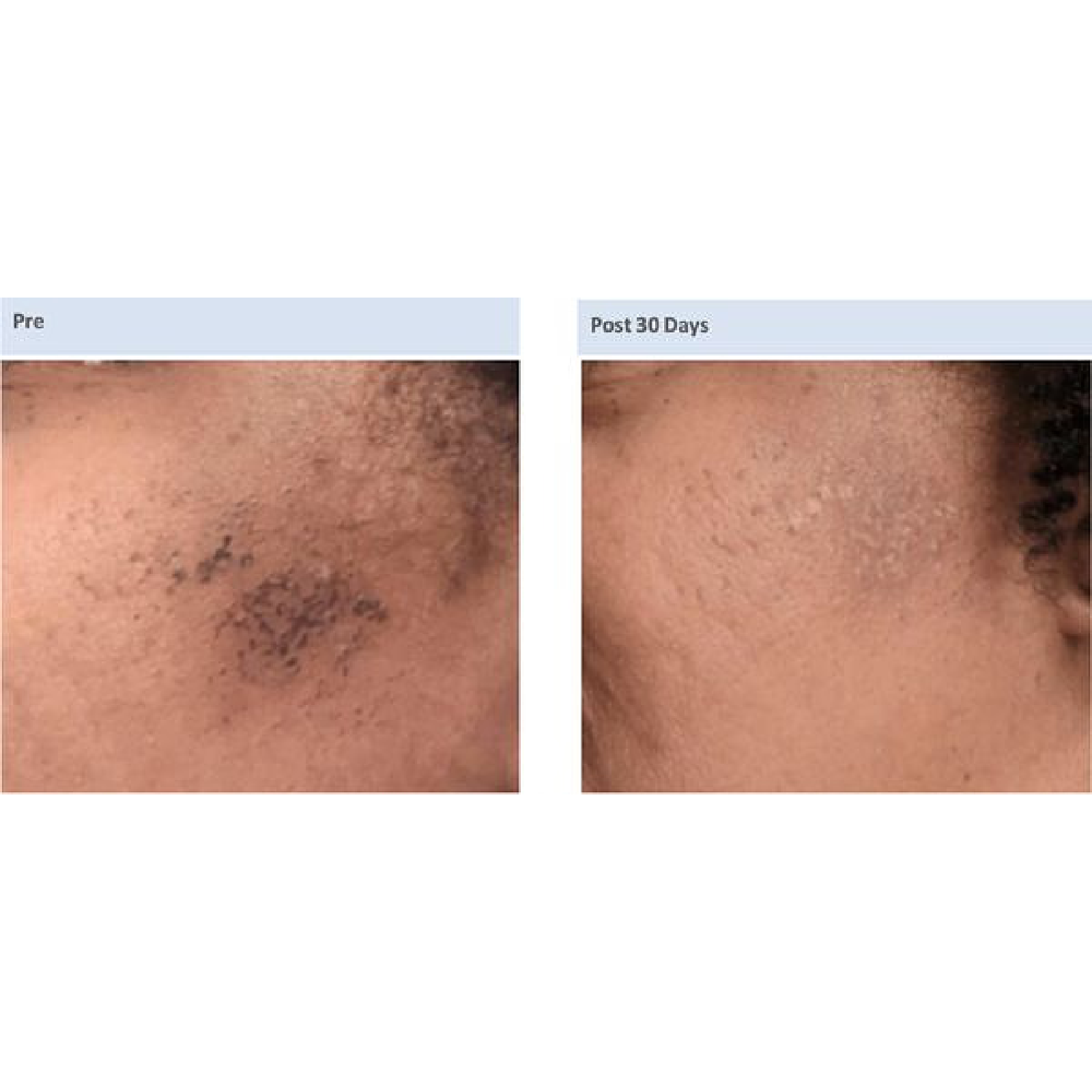 Gallery Laser Image Nine In Helena MT | Fyre Aesthetics