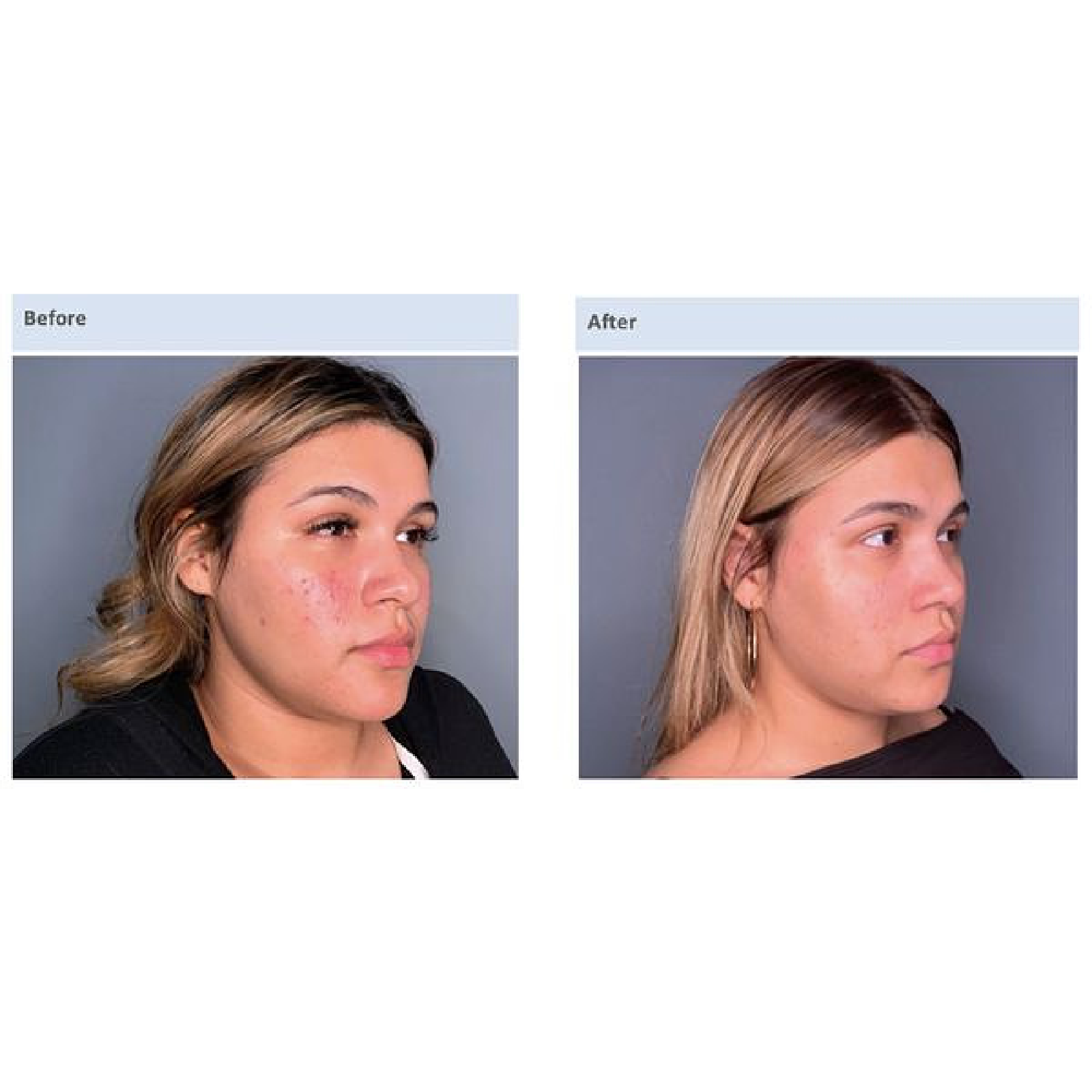 Gallery Laser Image Nineteen In Helena MT | Fyre Aesthetics