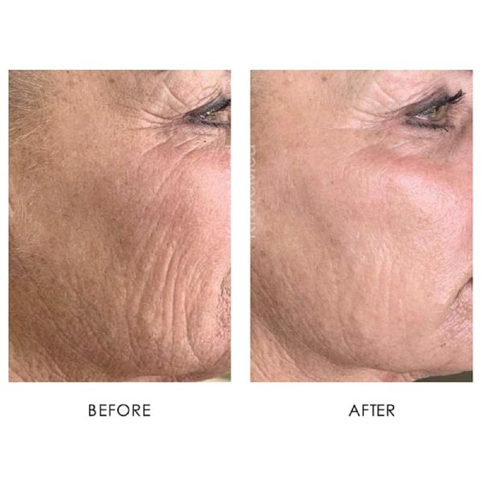 Gallery Laser Image One In Helena MT | Fyre Aesthetics