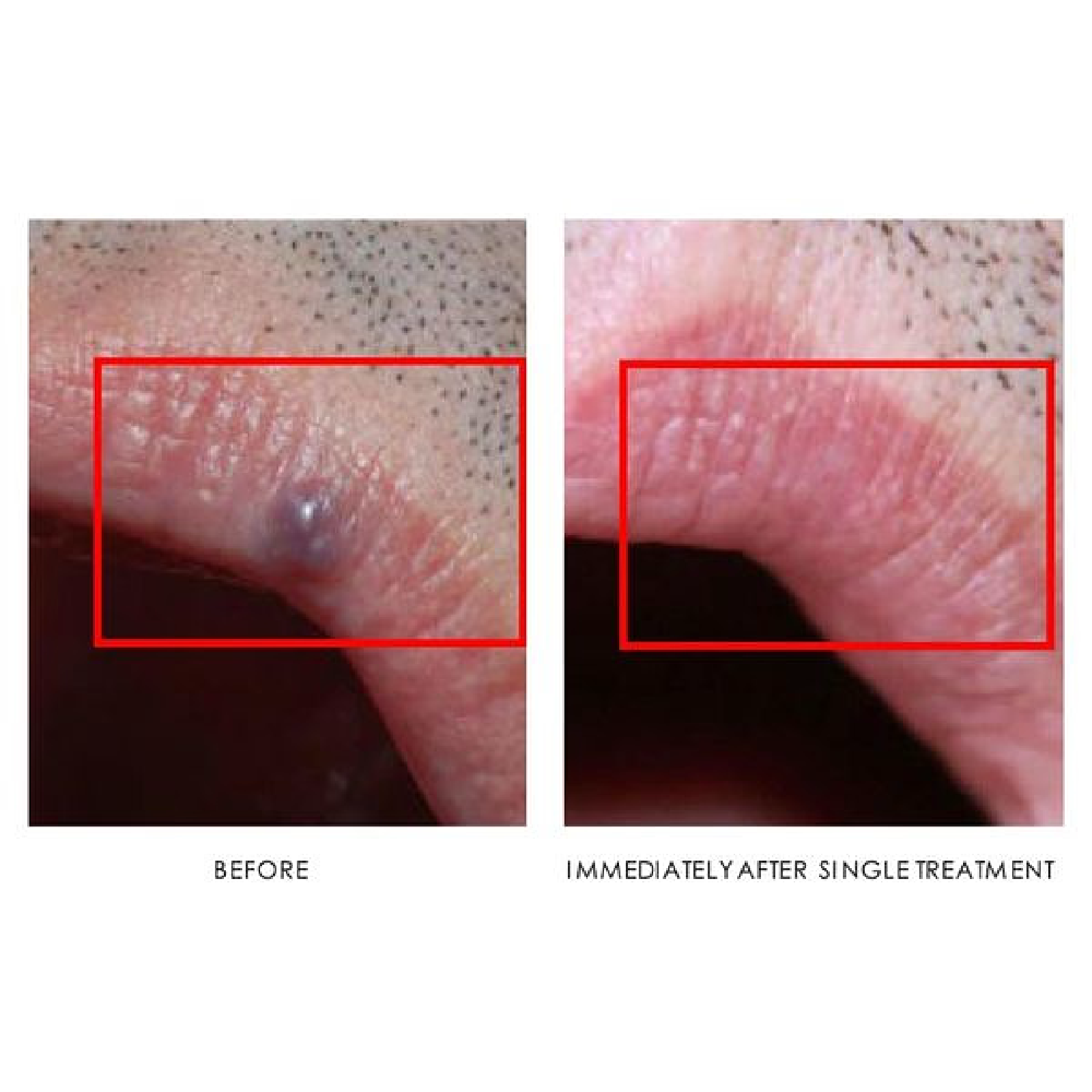 Gallery Laser Image Seventeen In Helena MT | Fyre Aesthetics