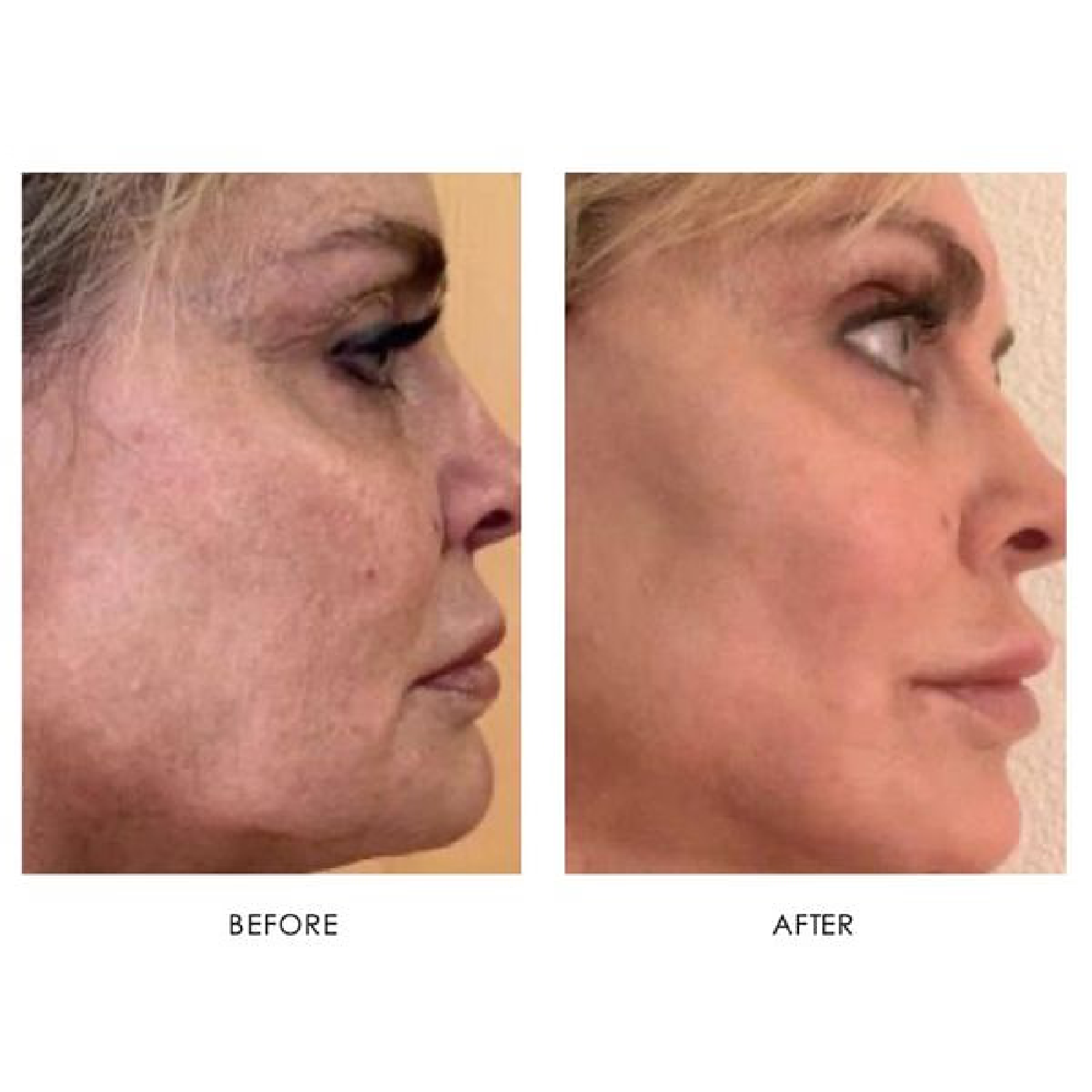 Gallery Laser Image Six In Helena MT | Fyre Aesthetics