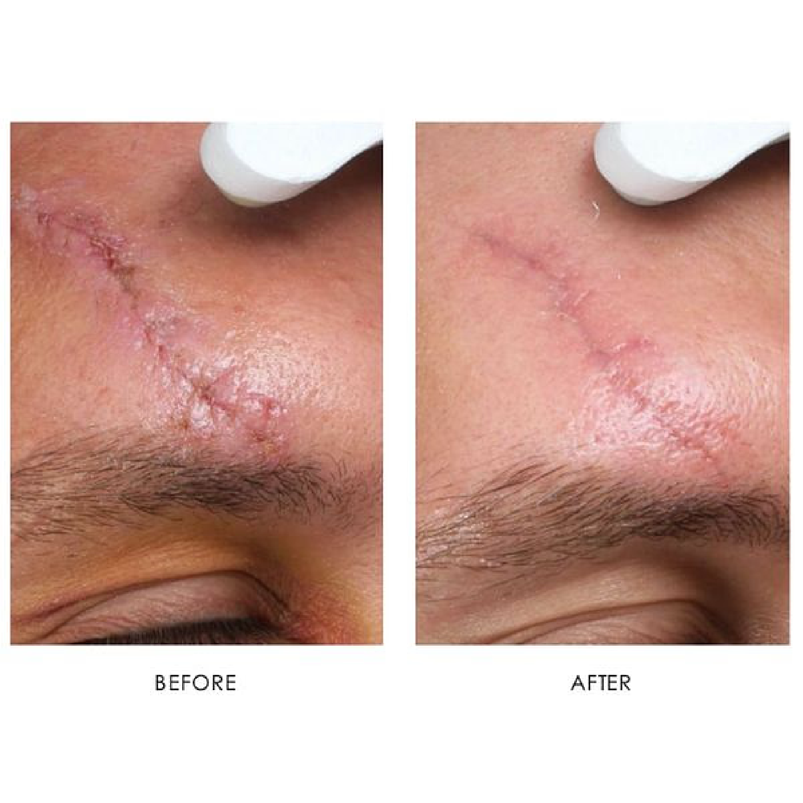 Gallery Laser Image Ten In Helena MT | Fyre Aesthetics