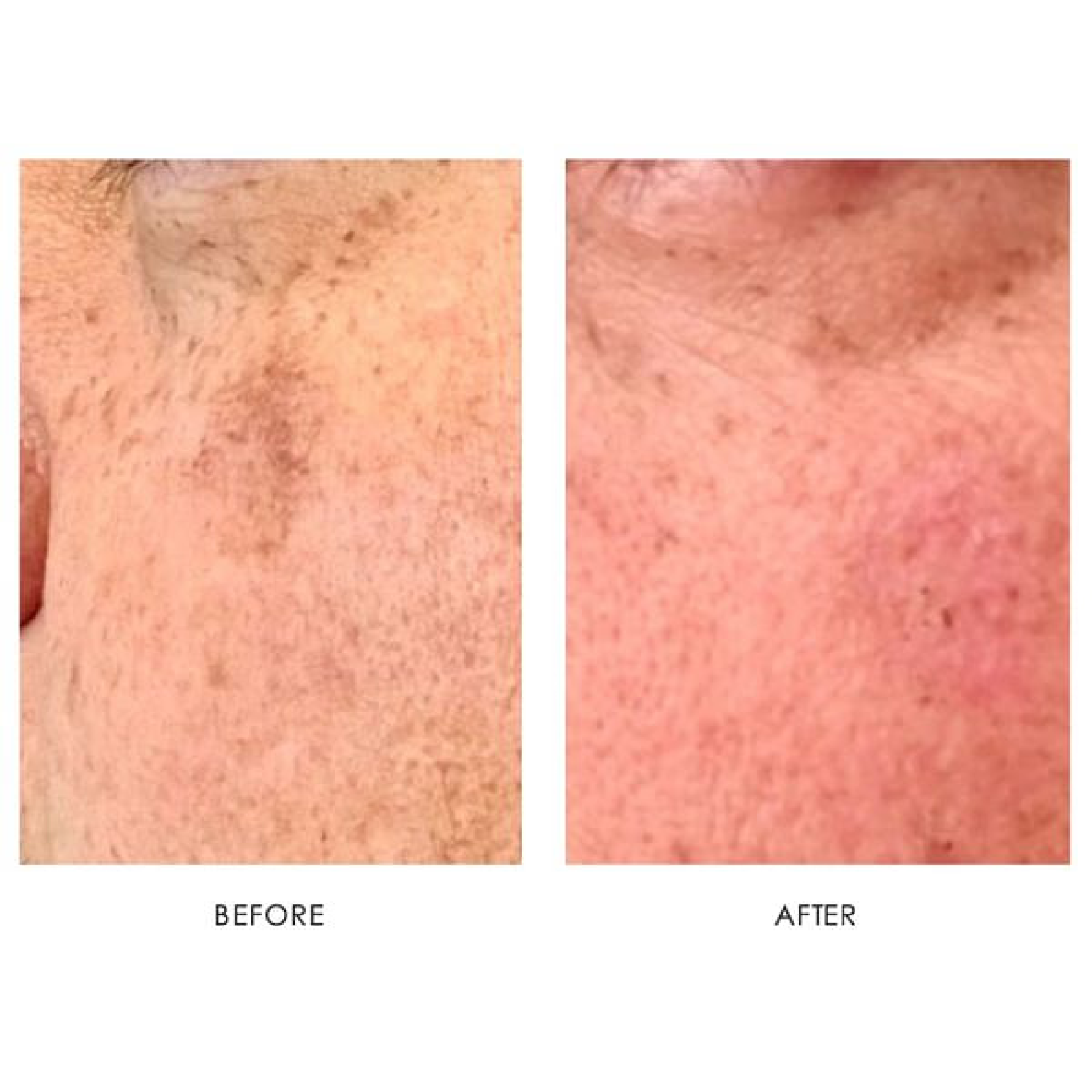 Gallery Laser Image Ten In Helena MT | Fyre Aesthetics