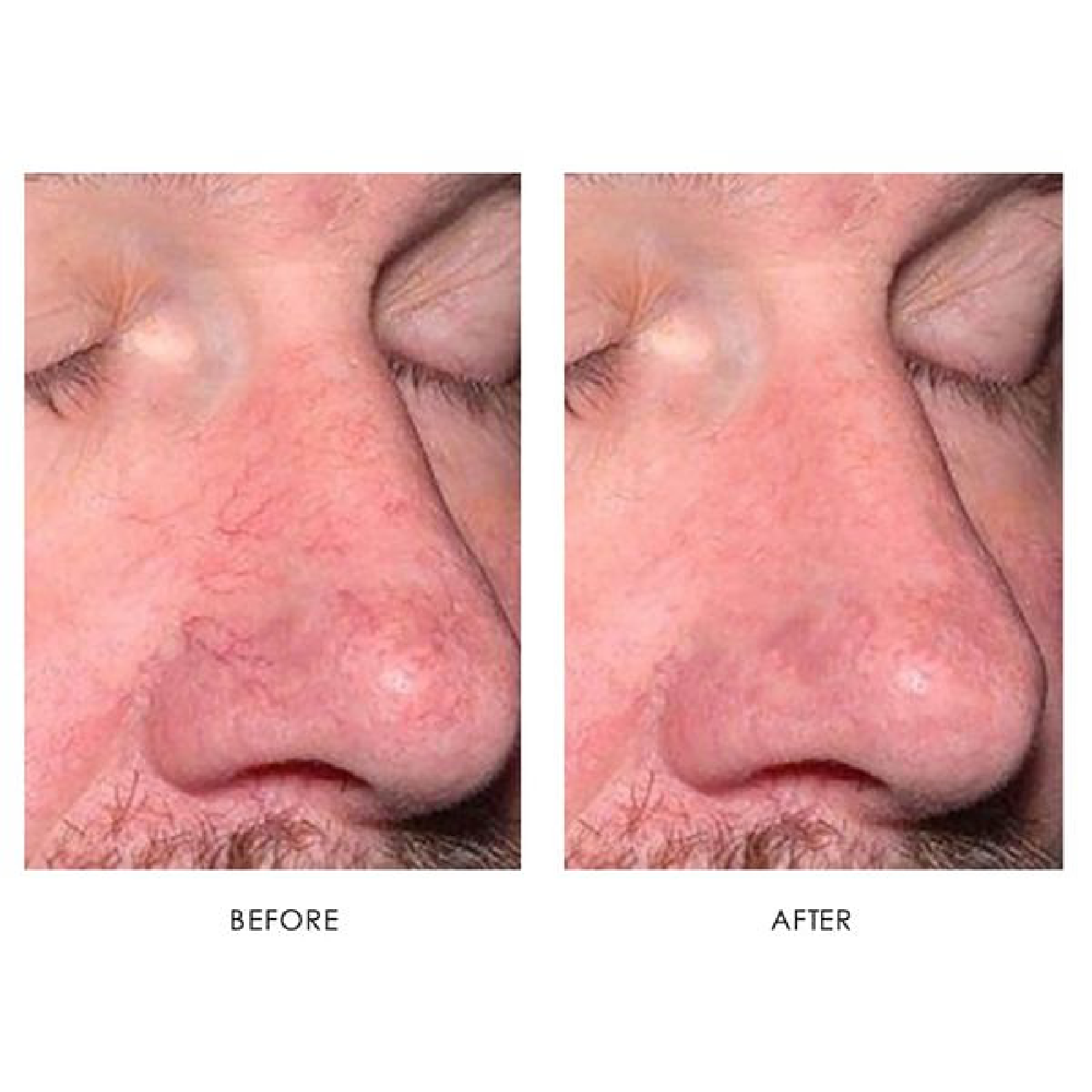 Gallery Laser Image Thirteen In Helena MT | Fyre Aesthetics