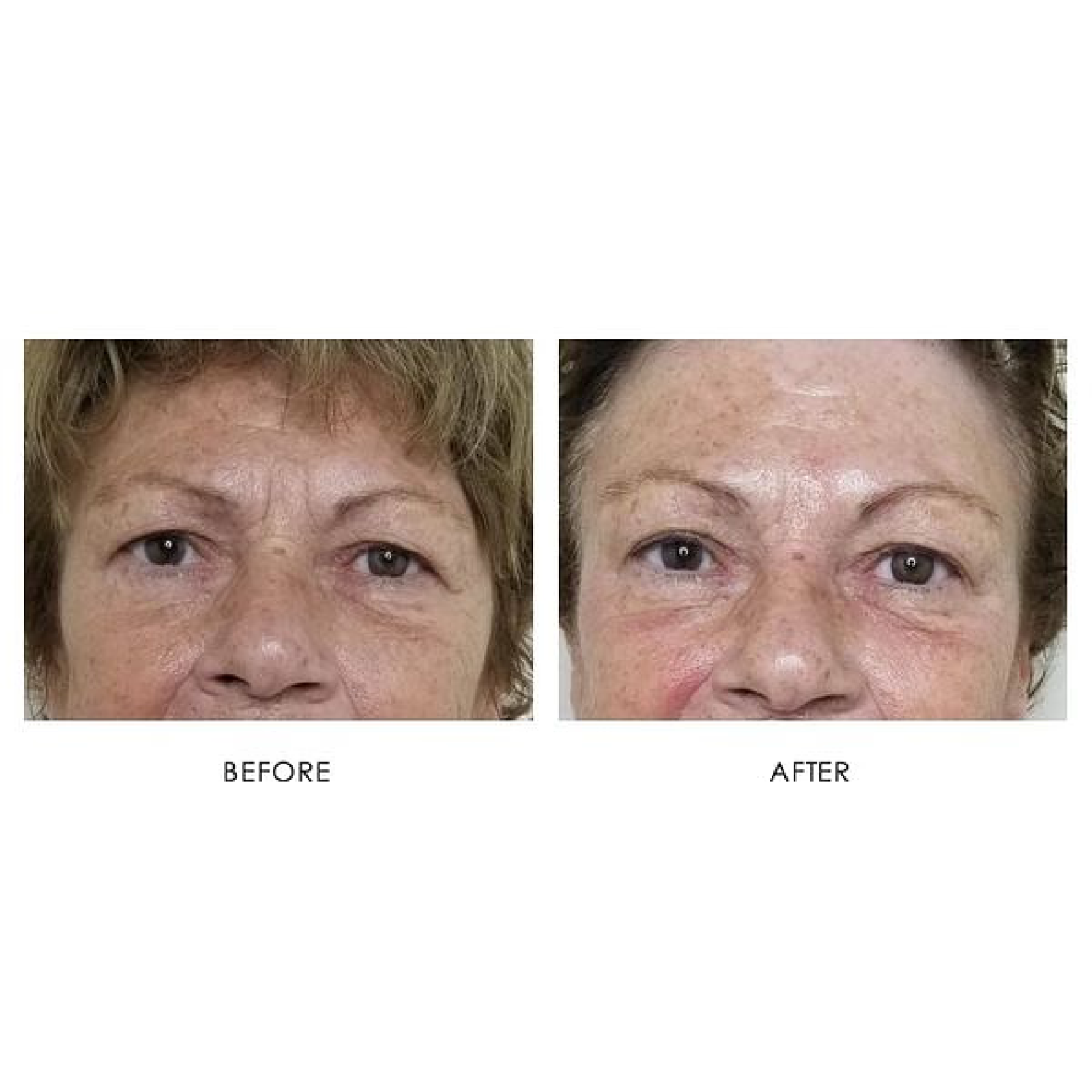 Gallery Laser Image Three In Helena MT | Fyre Aesthetics