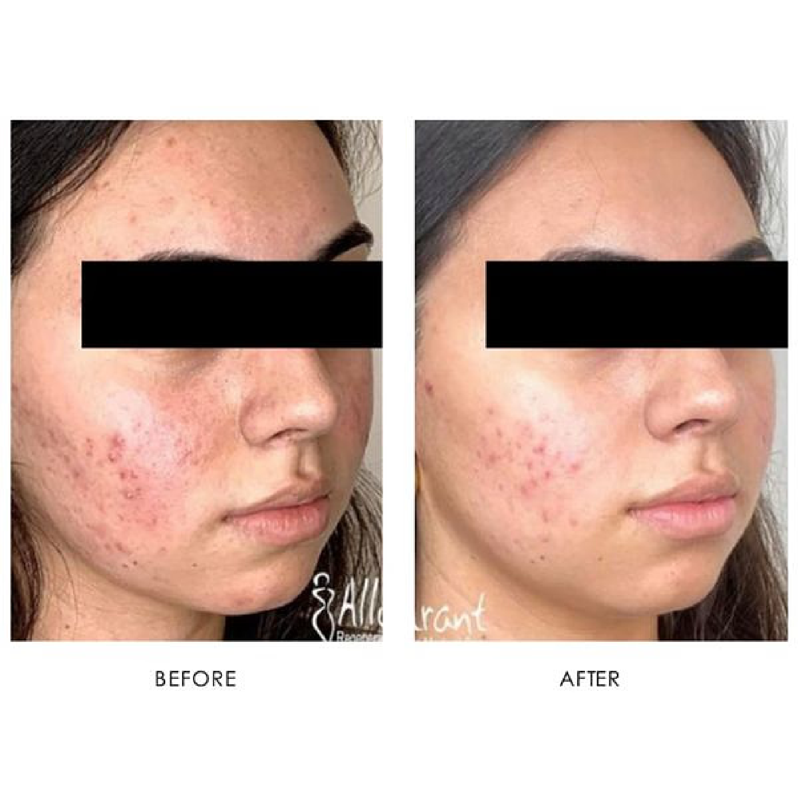 Gallery Laser Image Twenty Two In Helena MT | Fyre Aesthetics