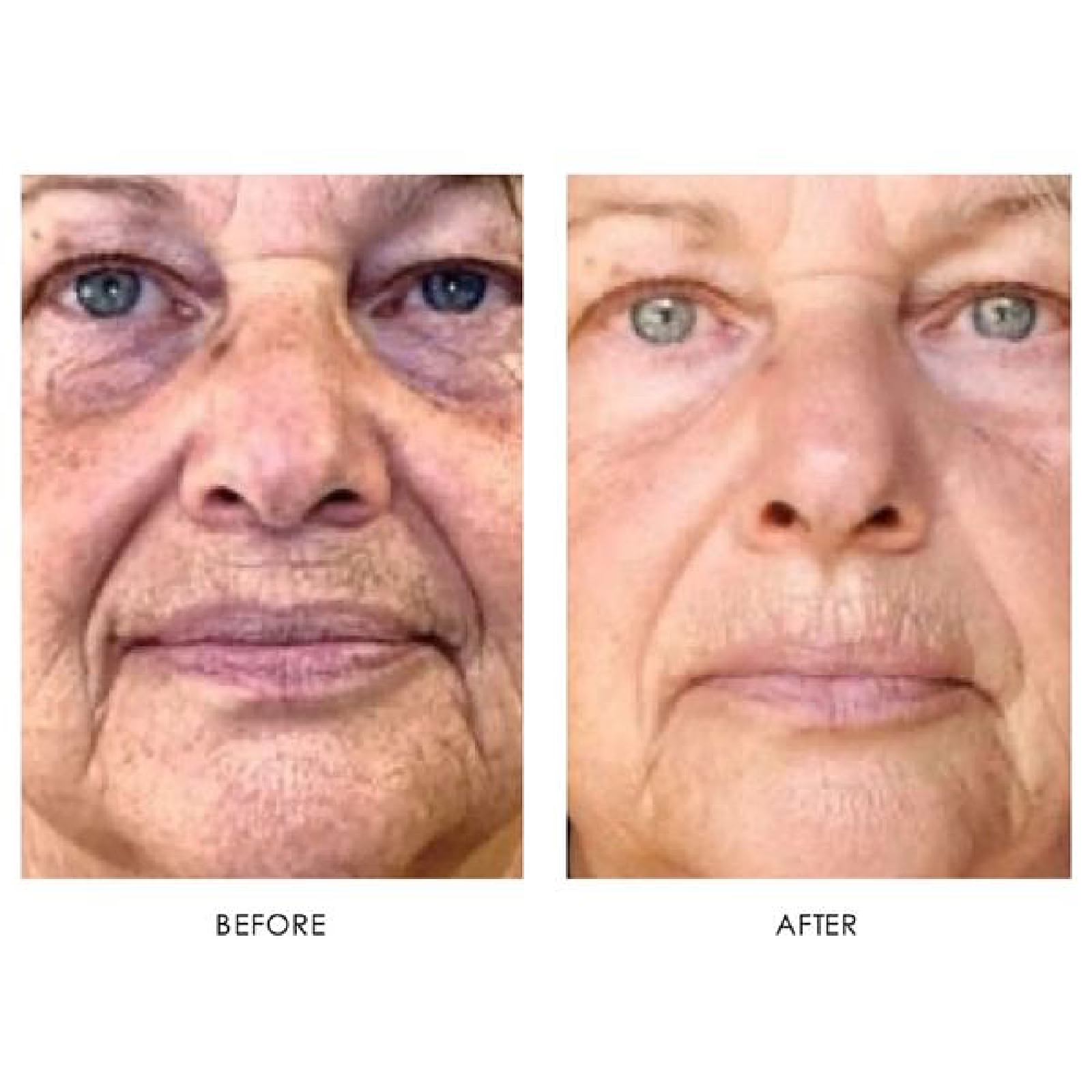 Gallery Laser Image Two In Helena MT | Fyre Aesthetics